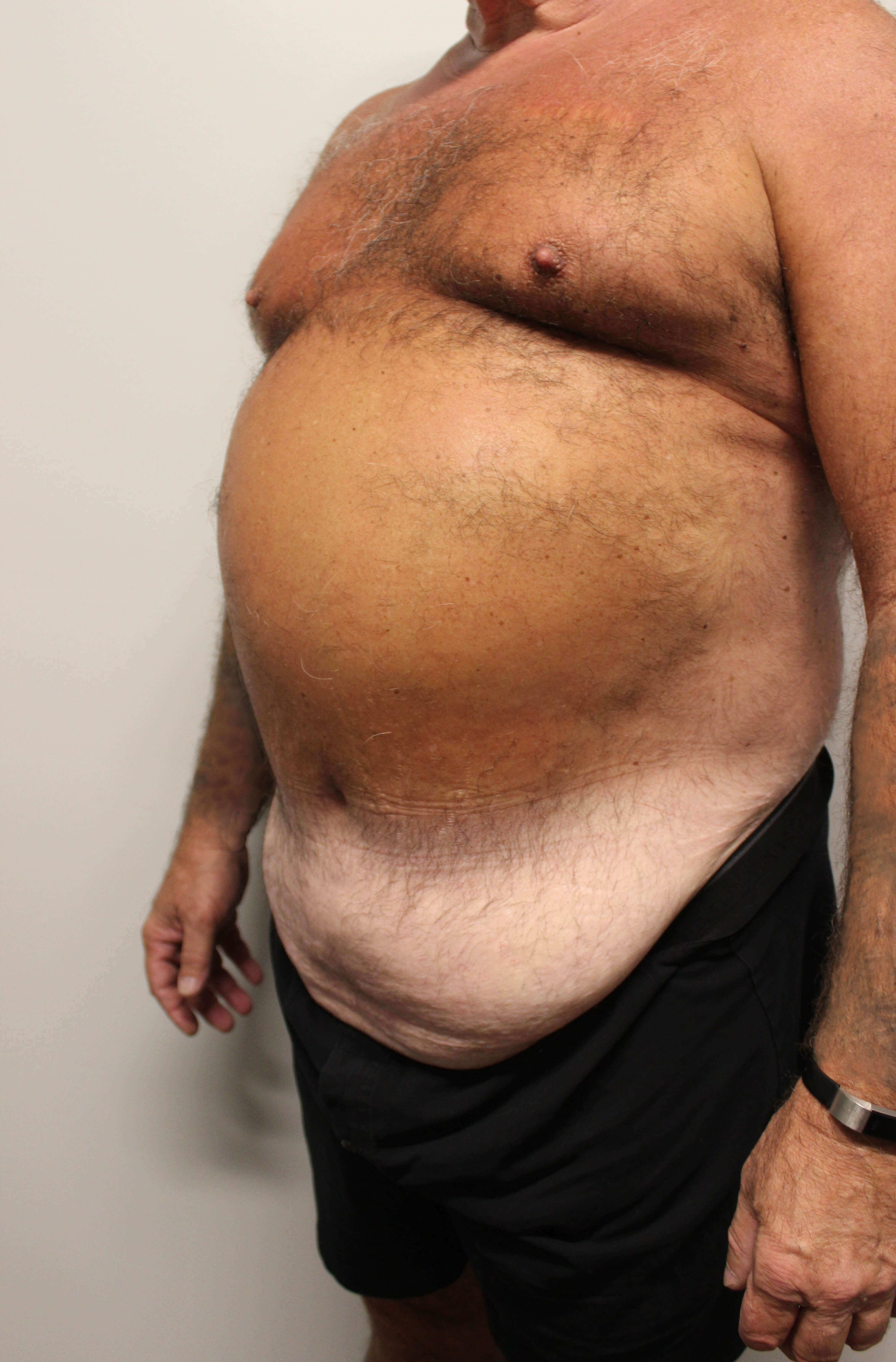 Male Tummy Tuck Before