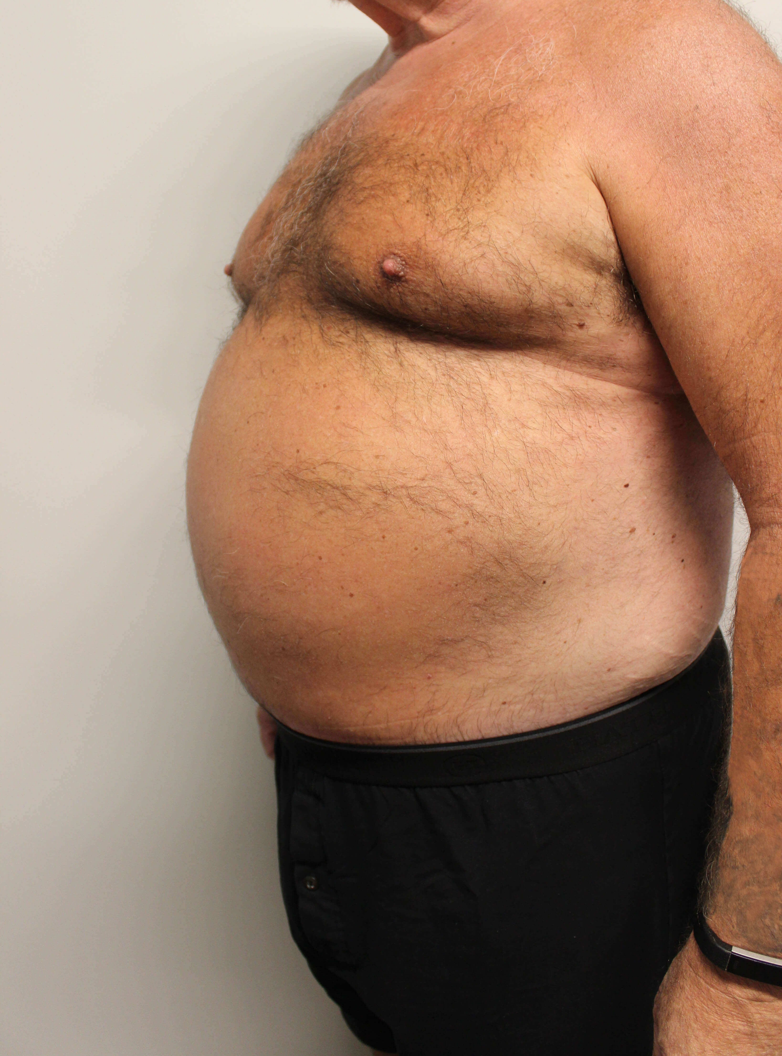 Male Tummy Tuck After