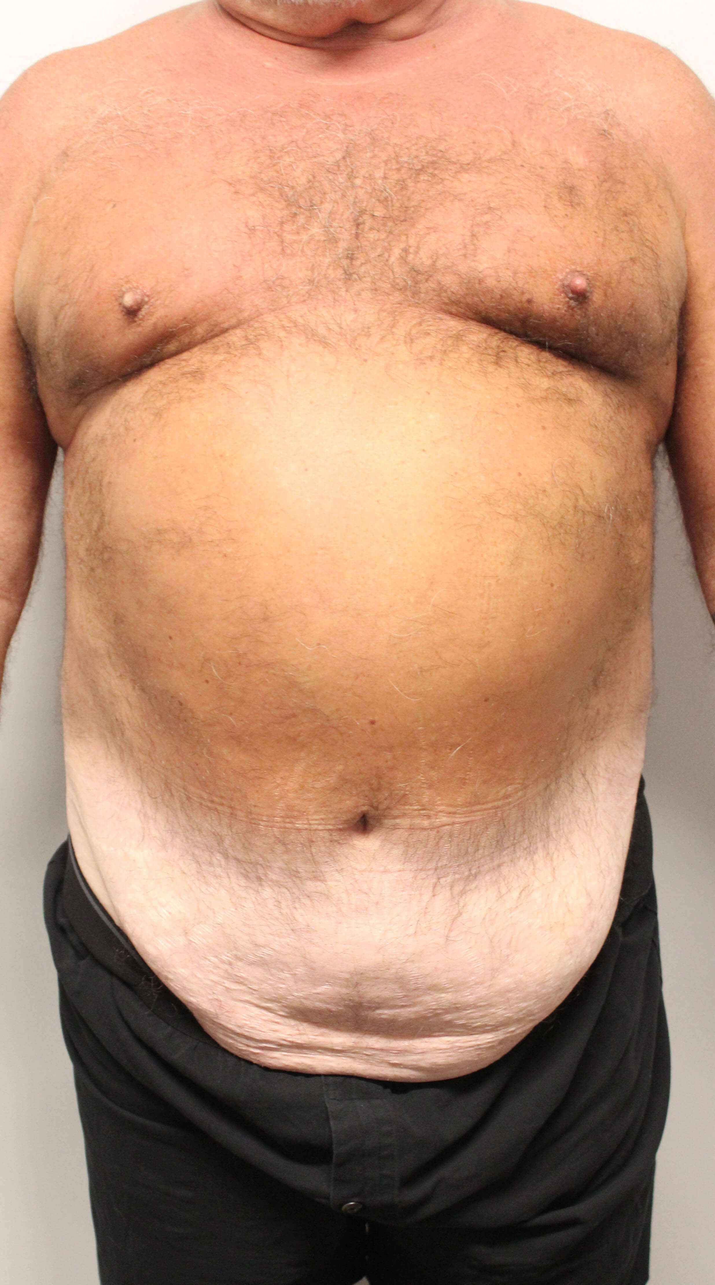 Male Tummy Tuck Before