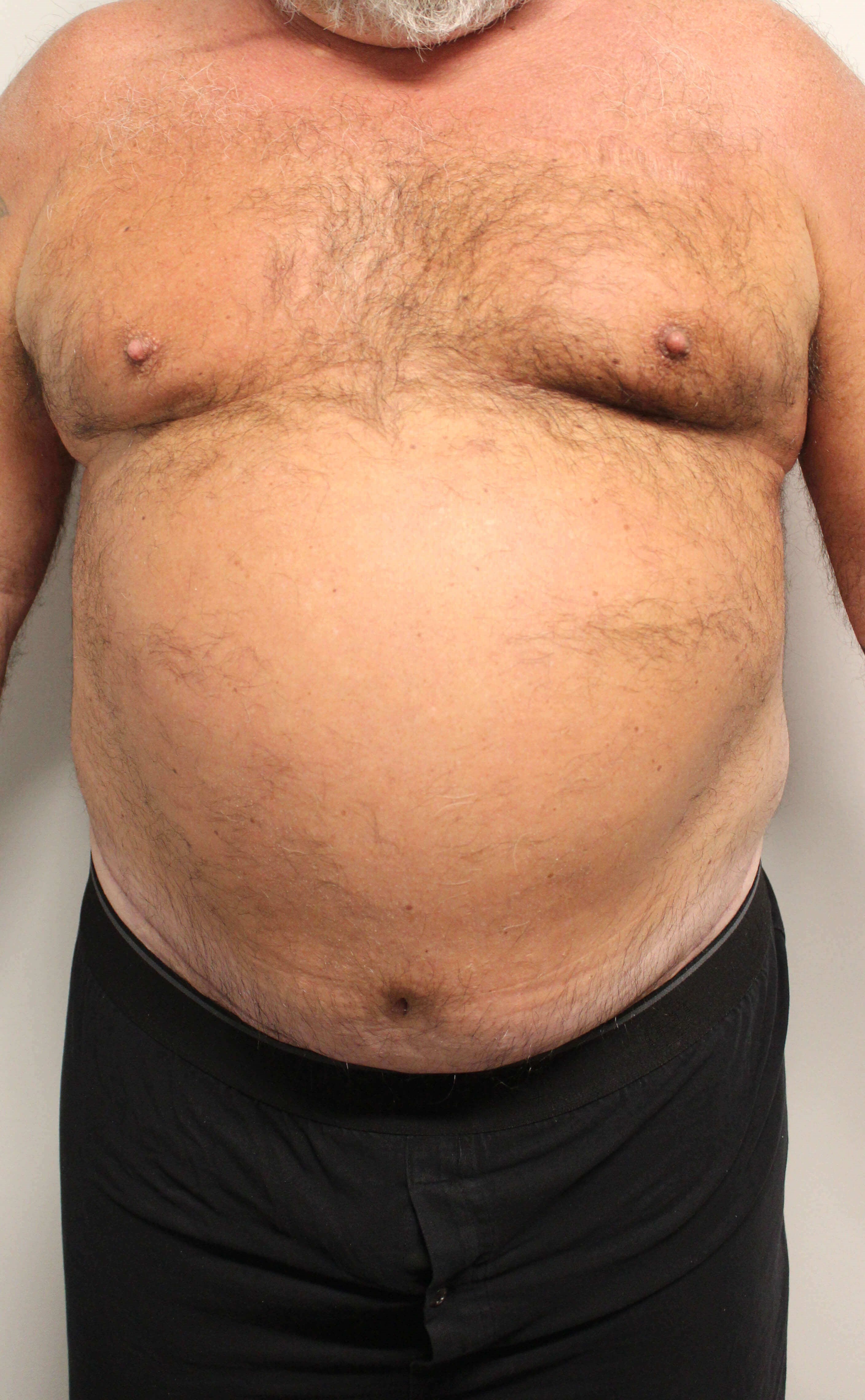 Male Tummy Tuck After