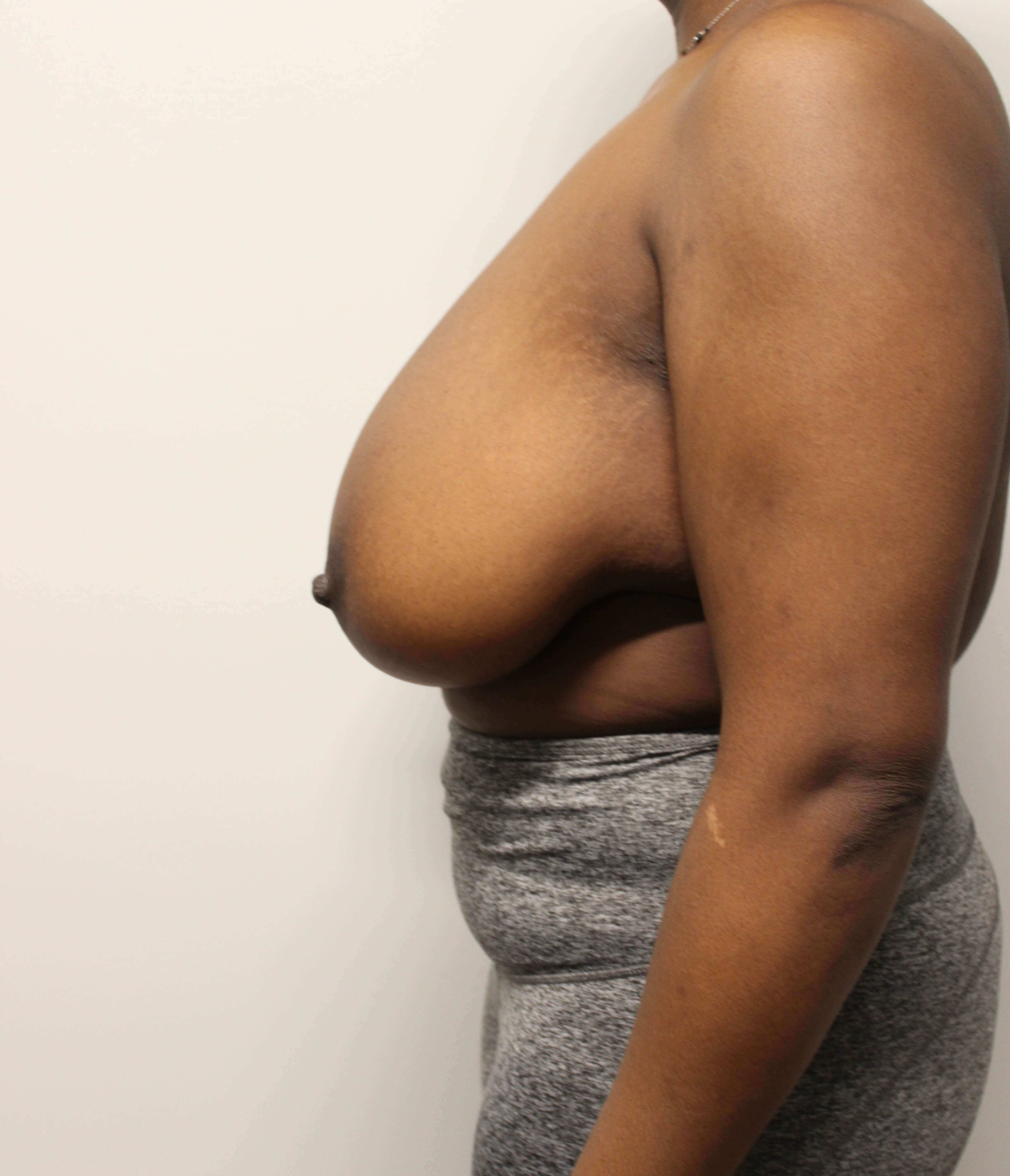 Breast Reduction Before