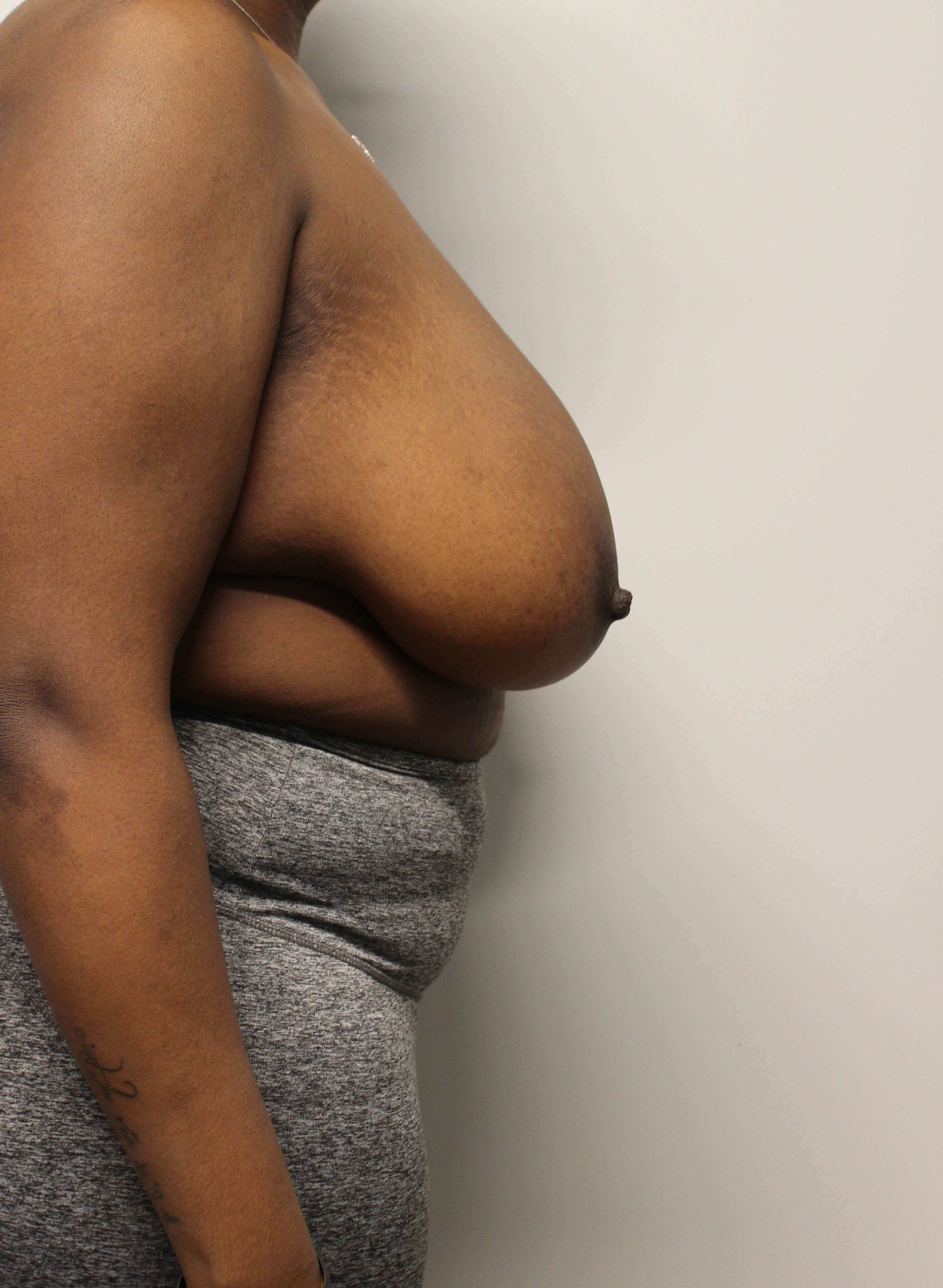 Breast Reduction Before