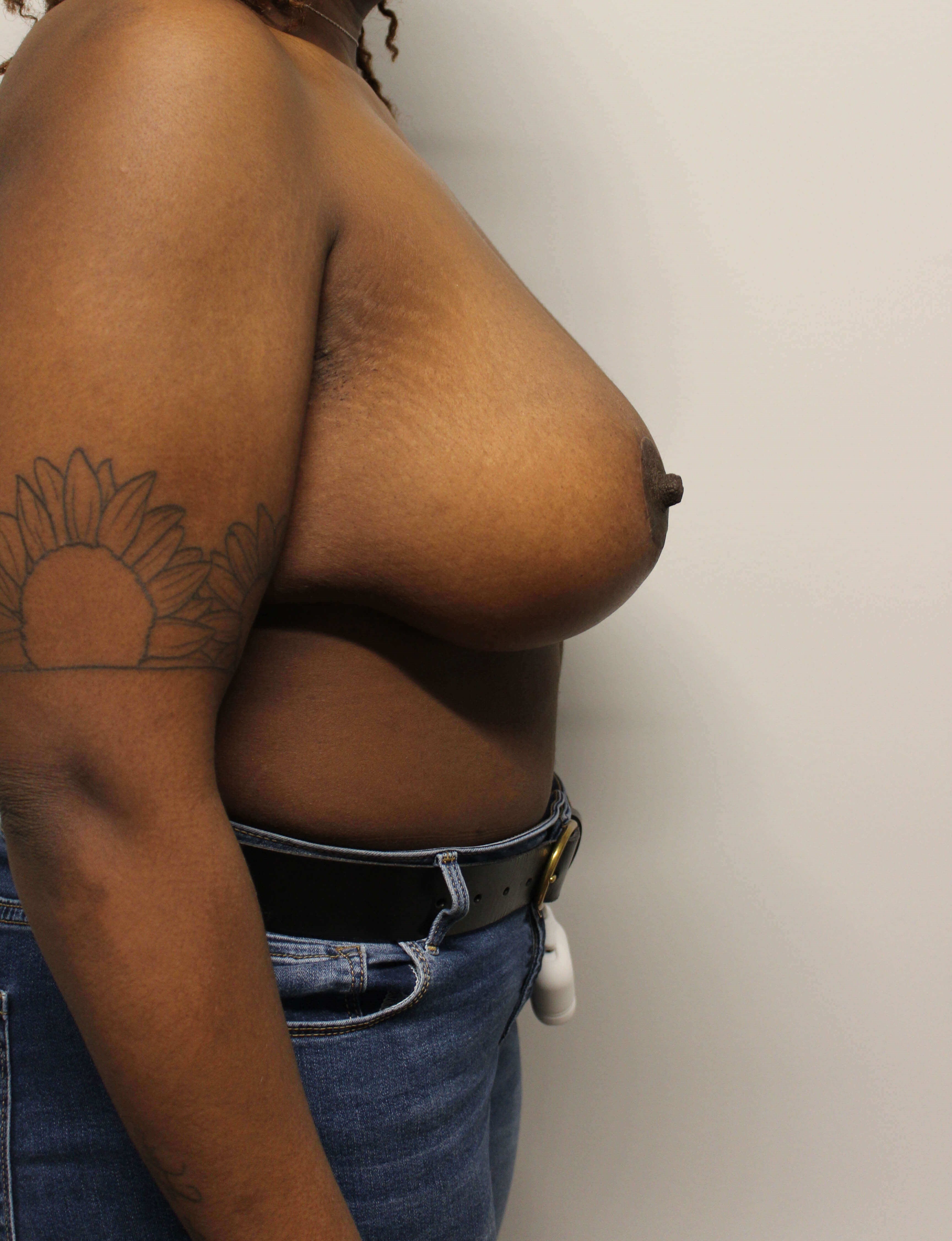 Breast Reduction After