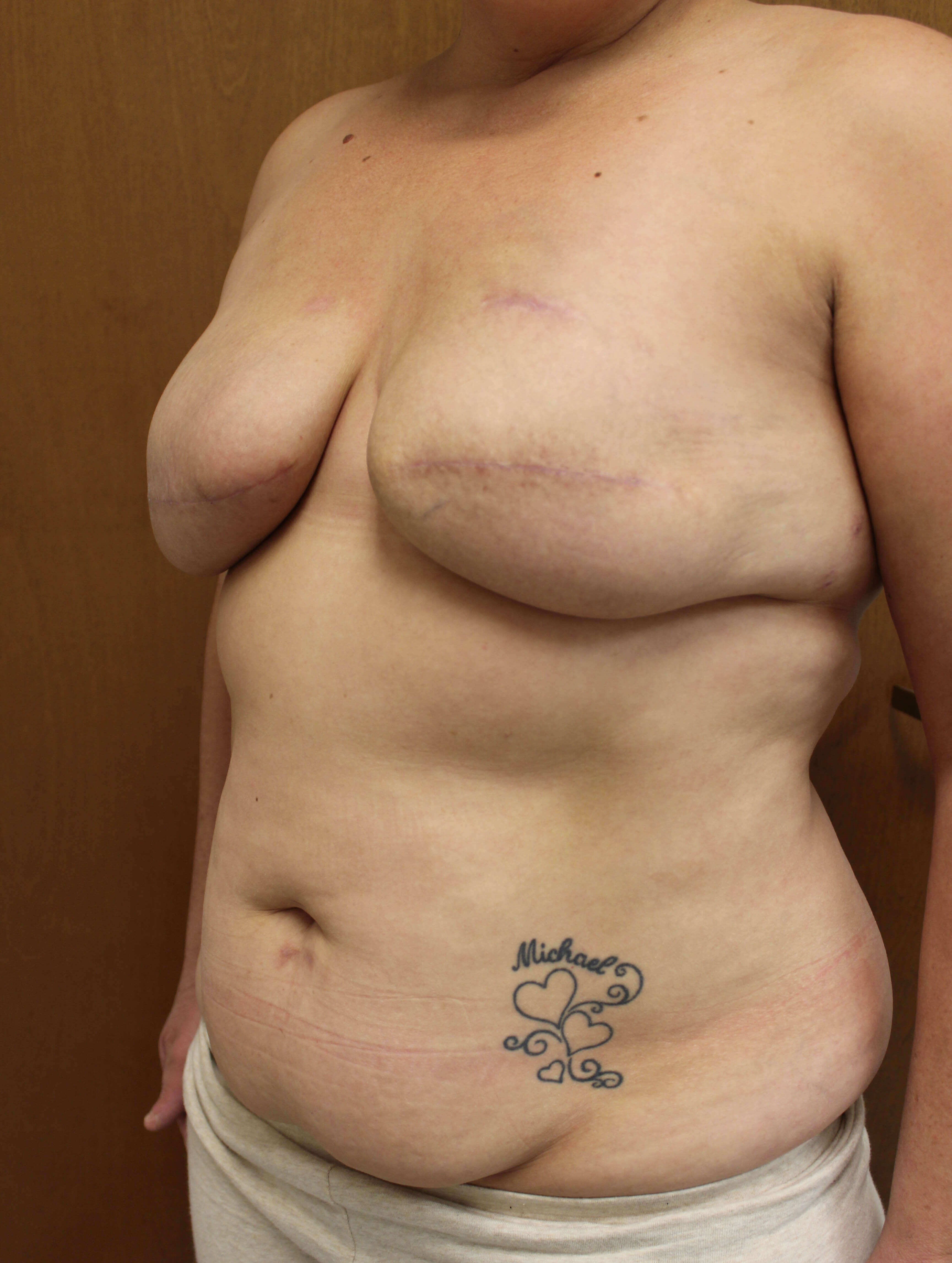 DIEP Flap Reconstruction Before