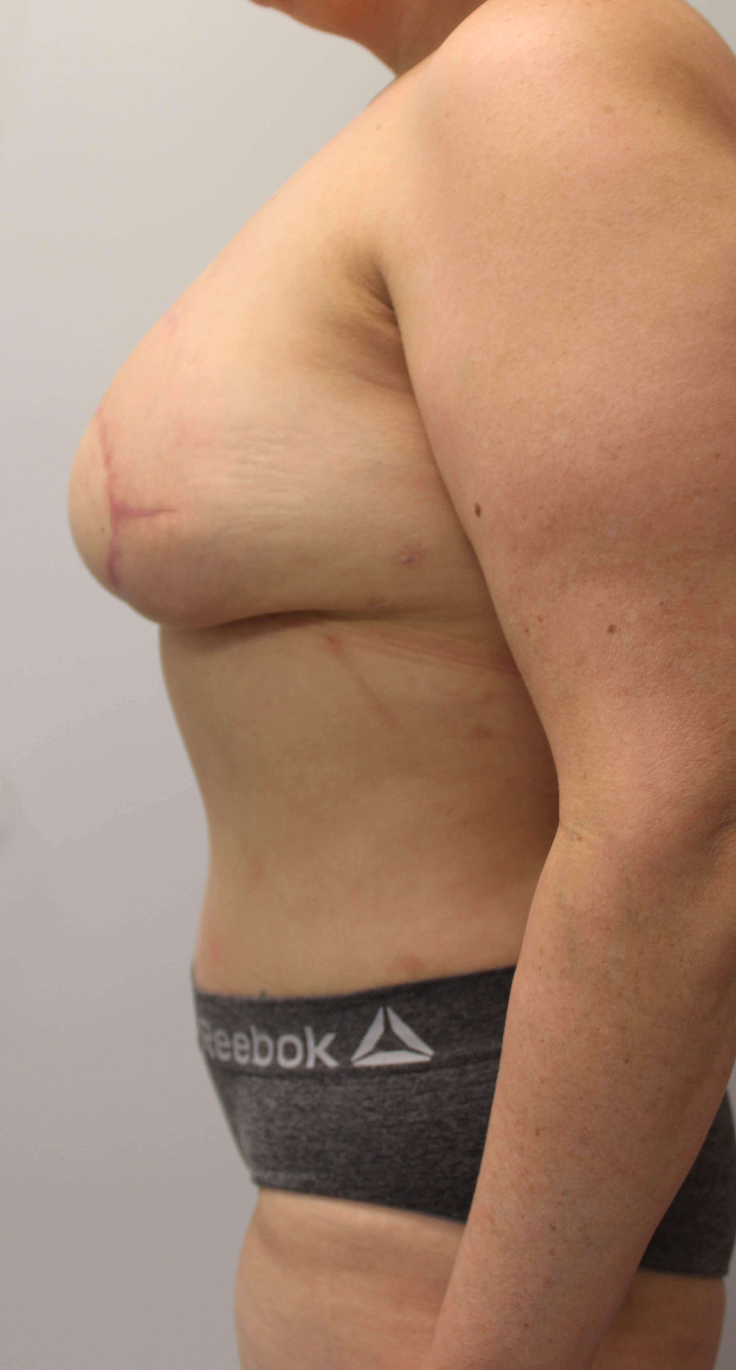 DIEP Flap Reconstruction After