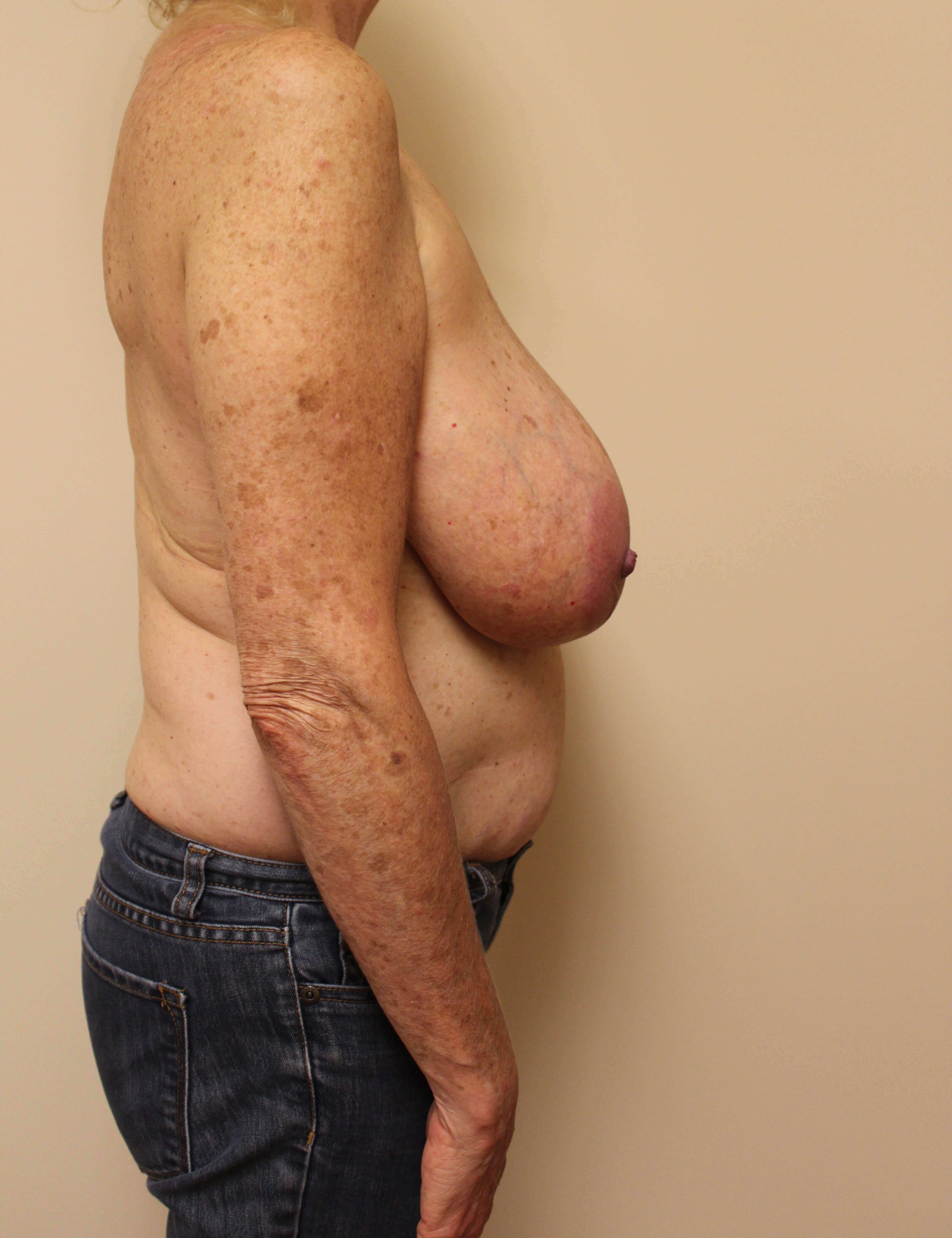 Tissue Expander with Reduction Before