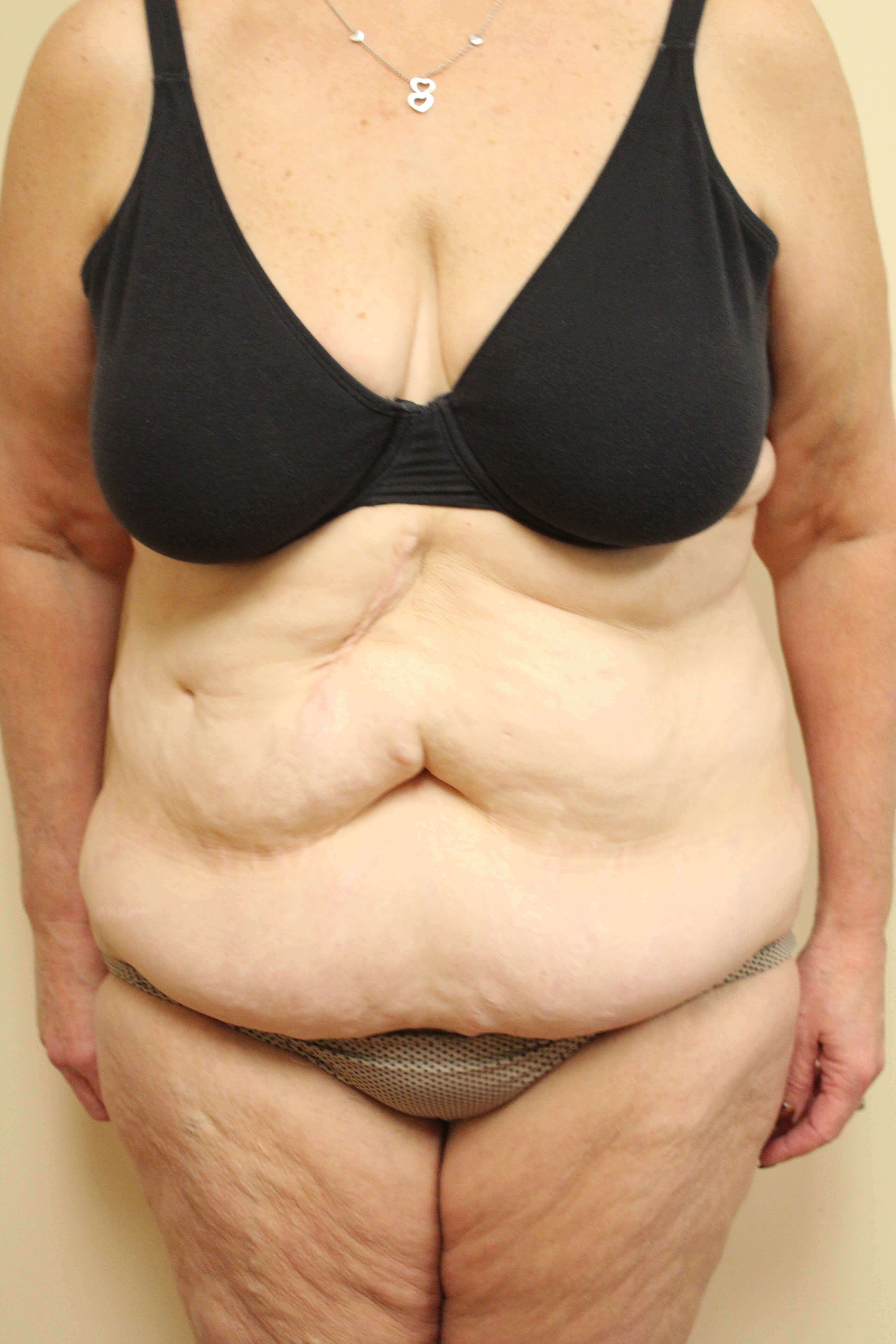 Tummy Tuck after weight loss Before