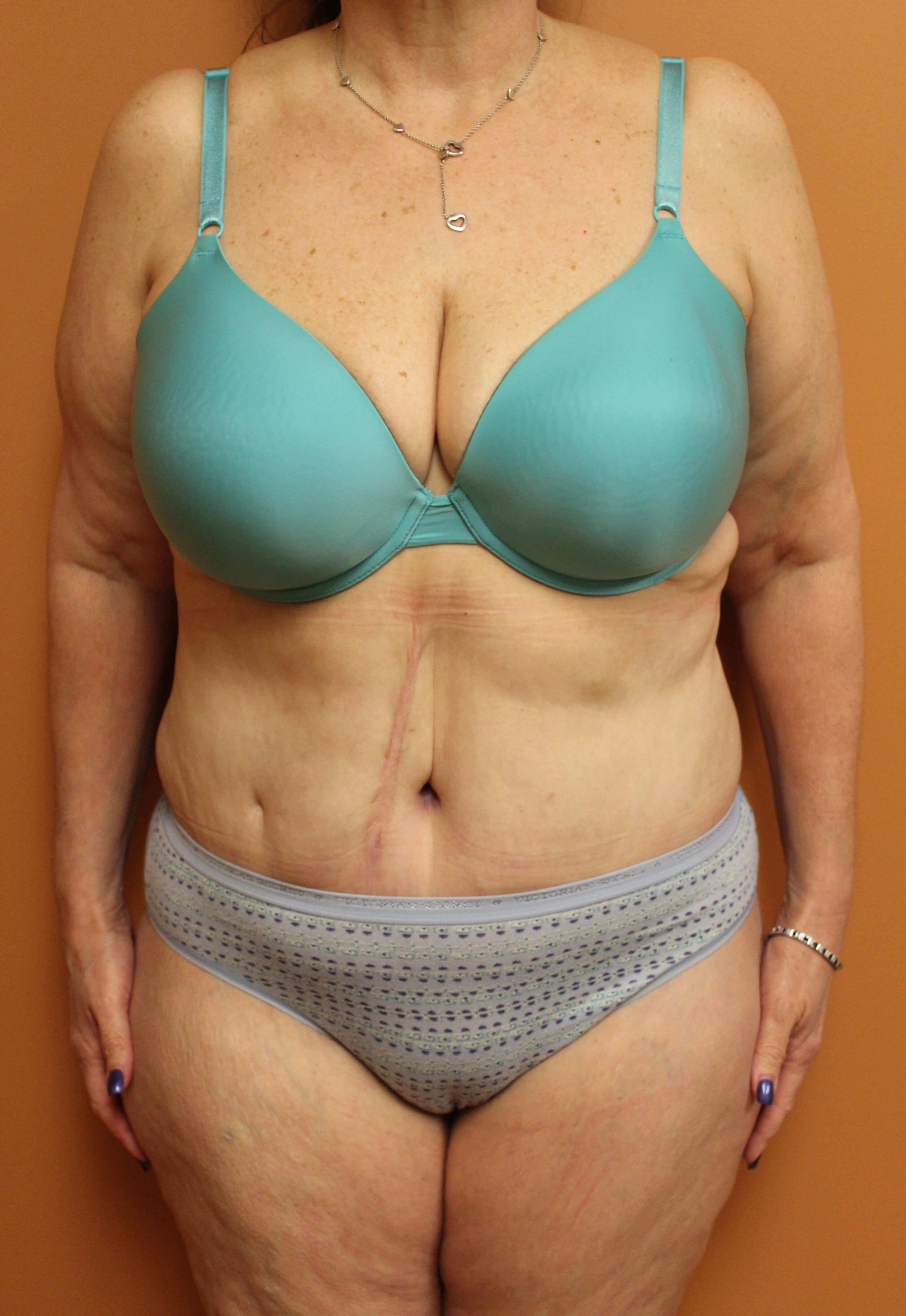 Tummy Tuck after weight loss After