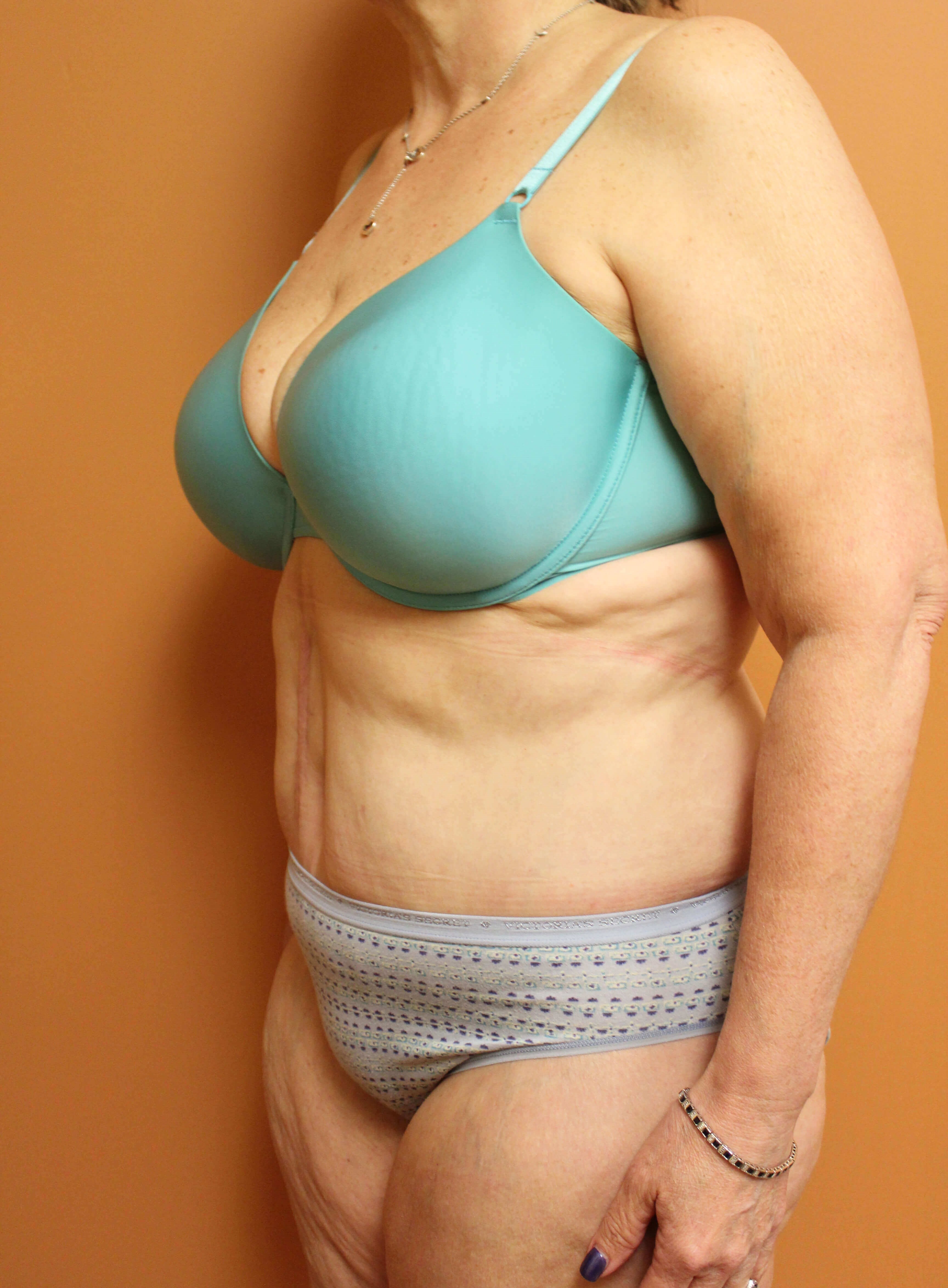 Tummy Tuck after weight loss After