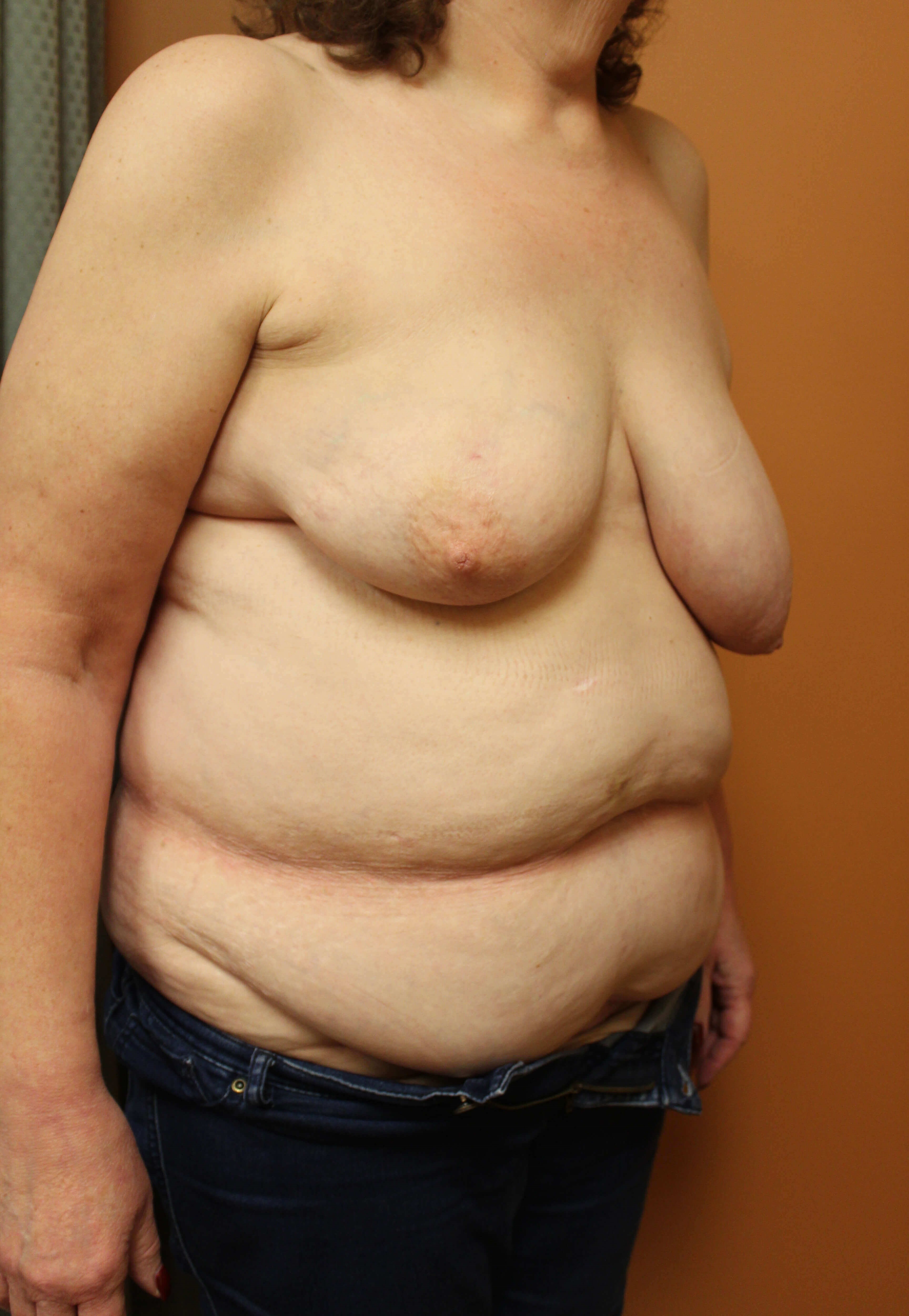 Right DIEP Flap Reconstruction Before