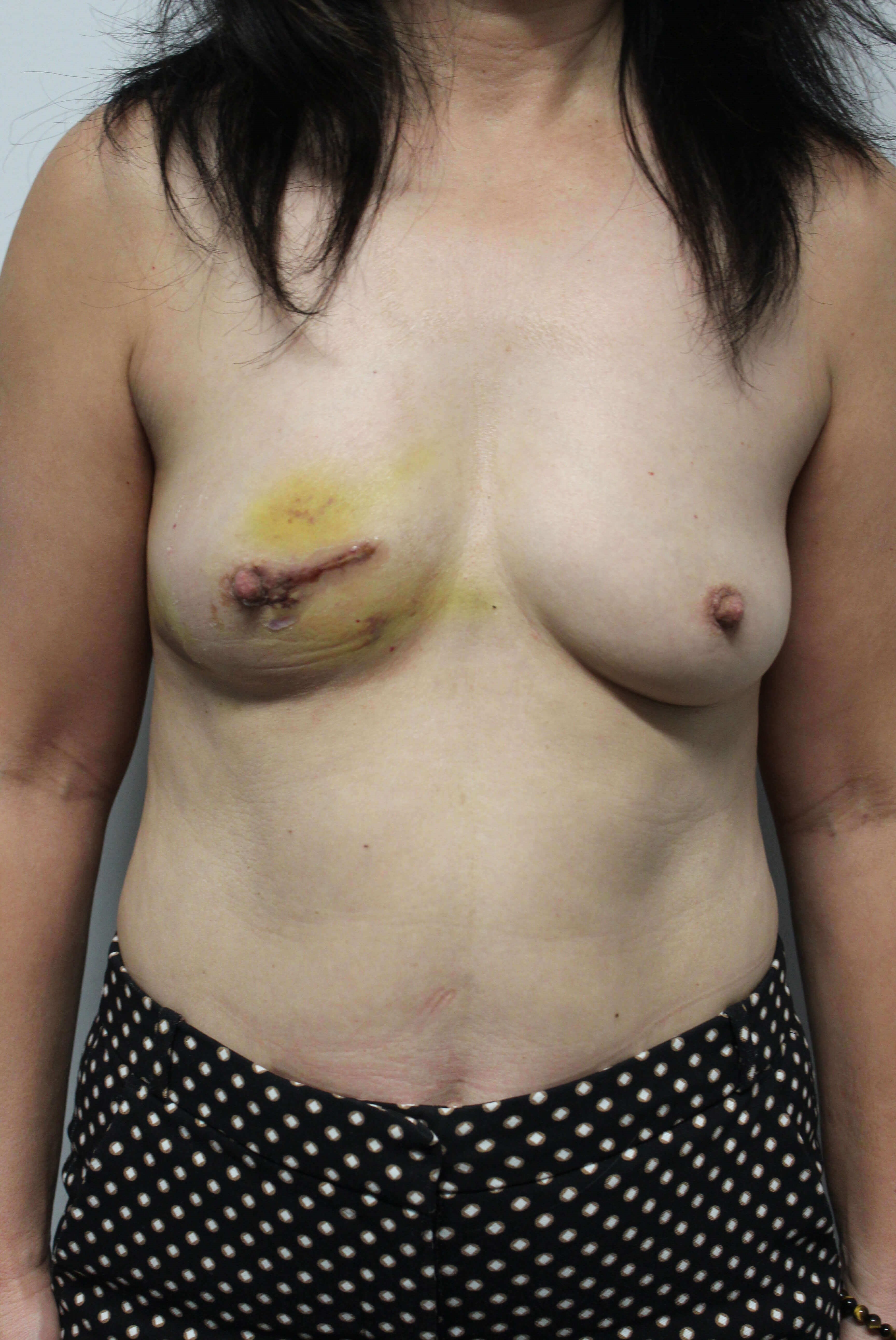 Direct to Implant Surgery Before