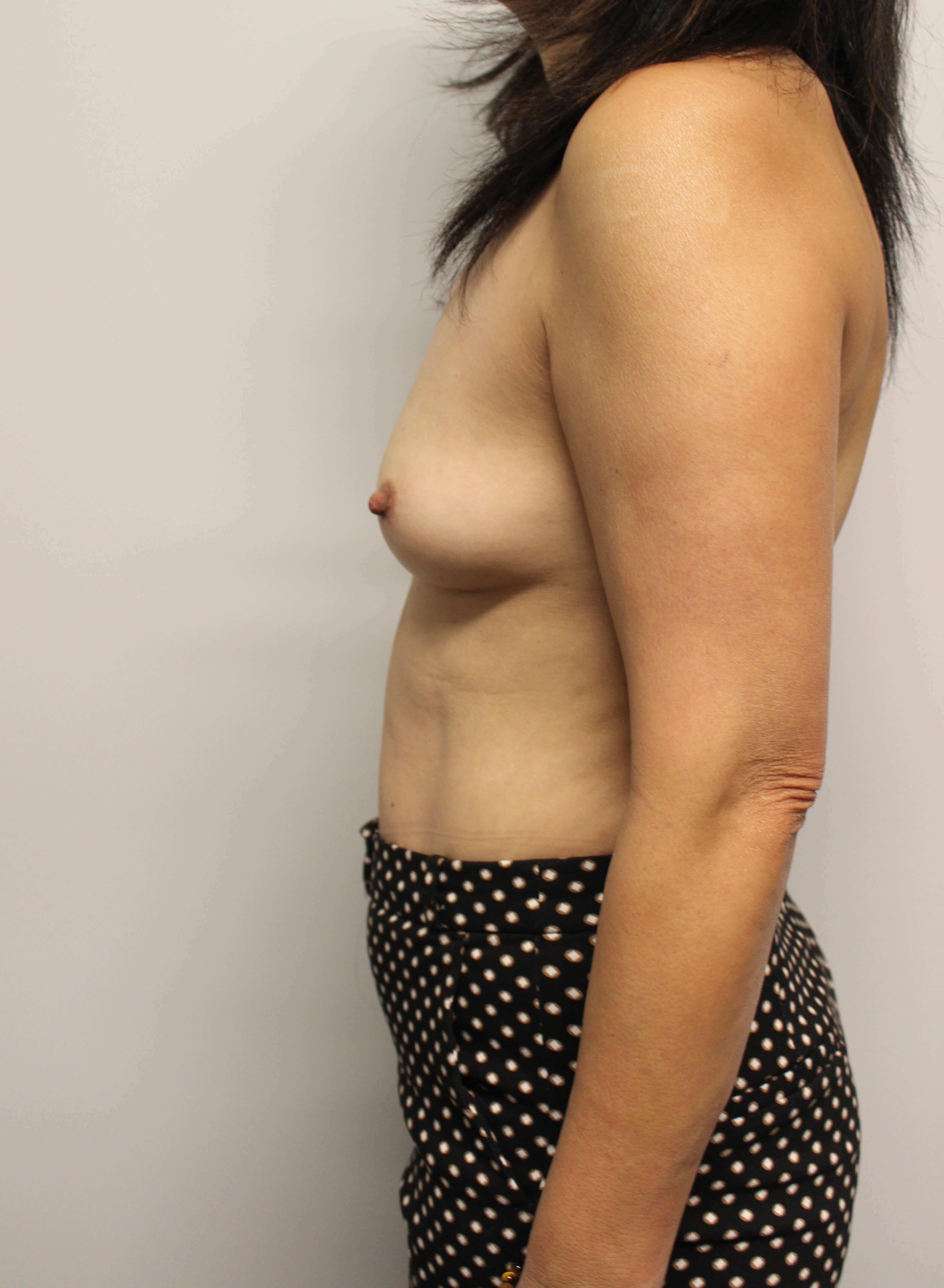 Direct to Implant Surgery Before