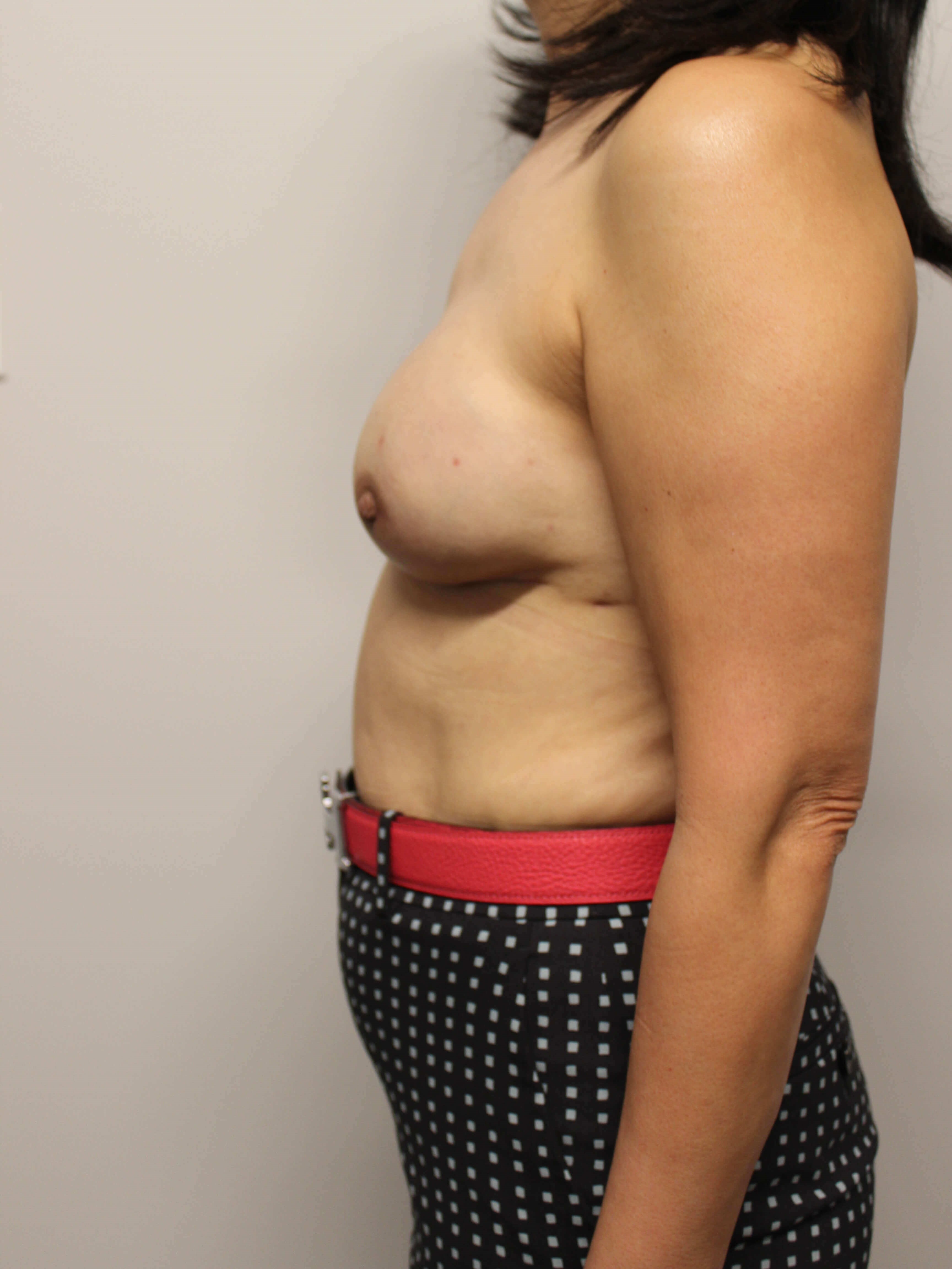 Direct to Implant Surgery After