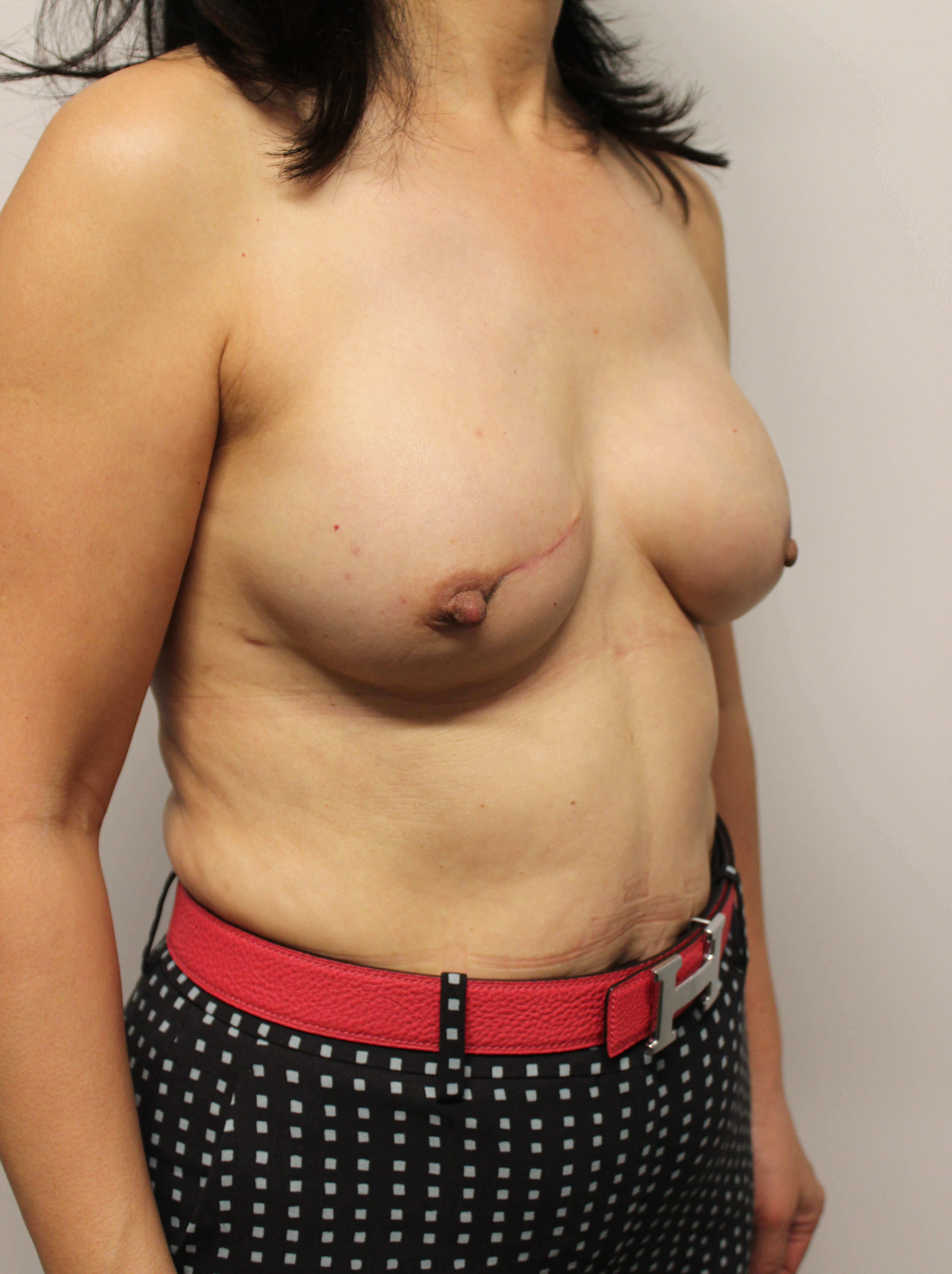 Direct to Implant Surgery After