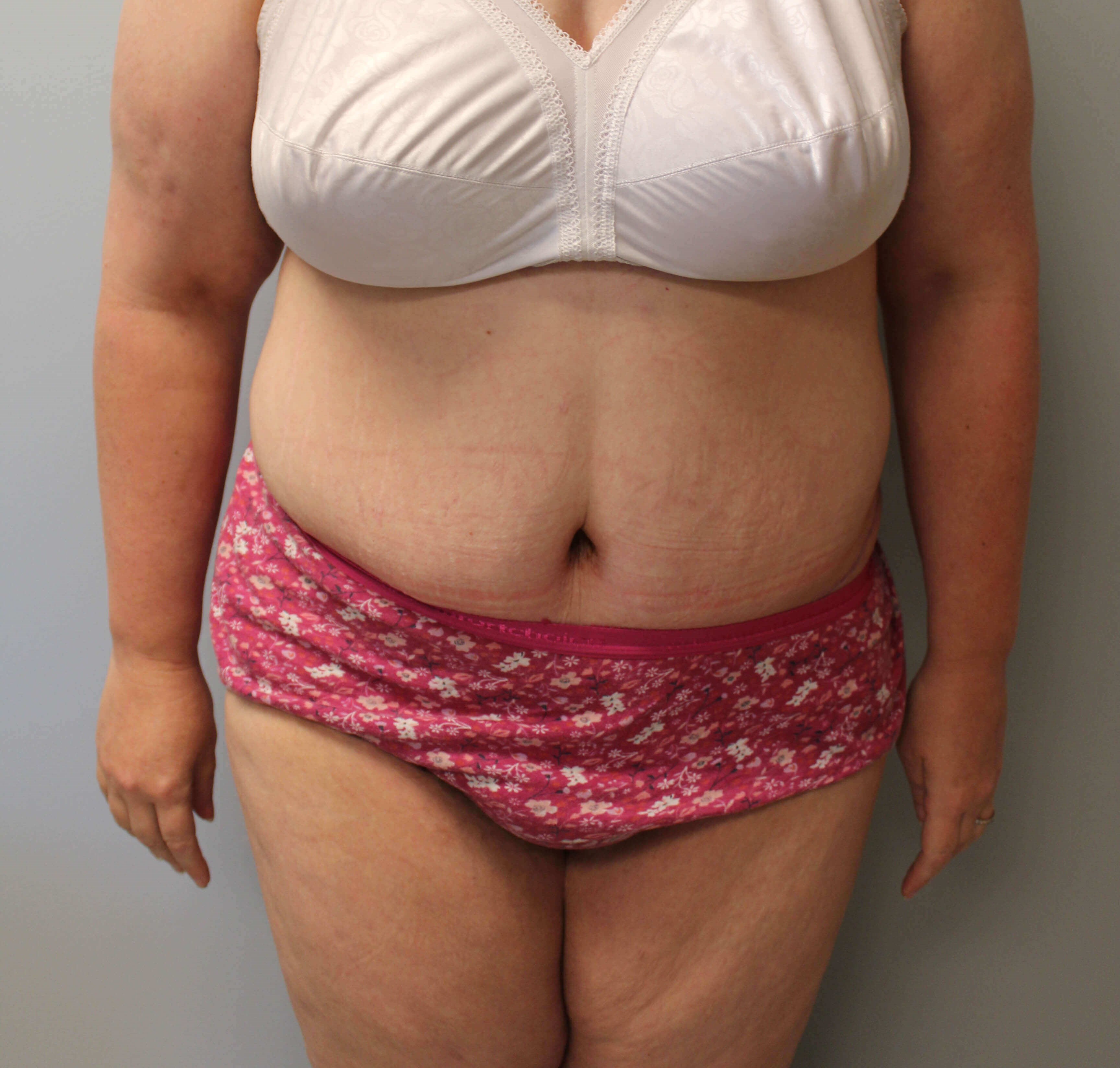 Tummy Tuck after weight loss After