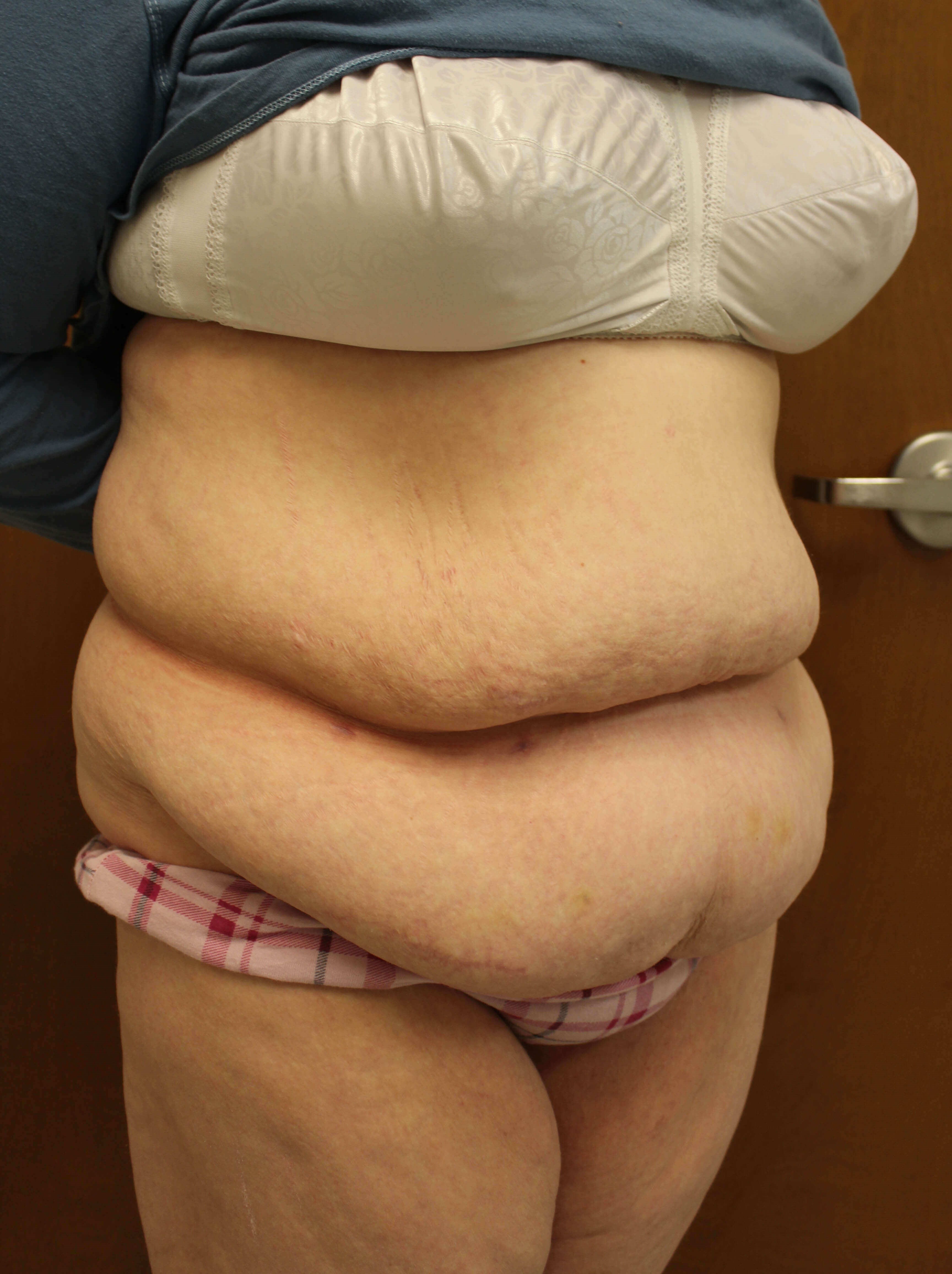 Tummy Tuck after weight loss Before