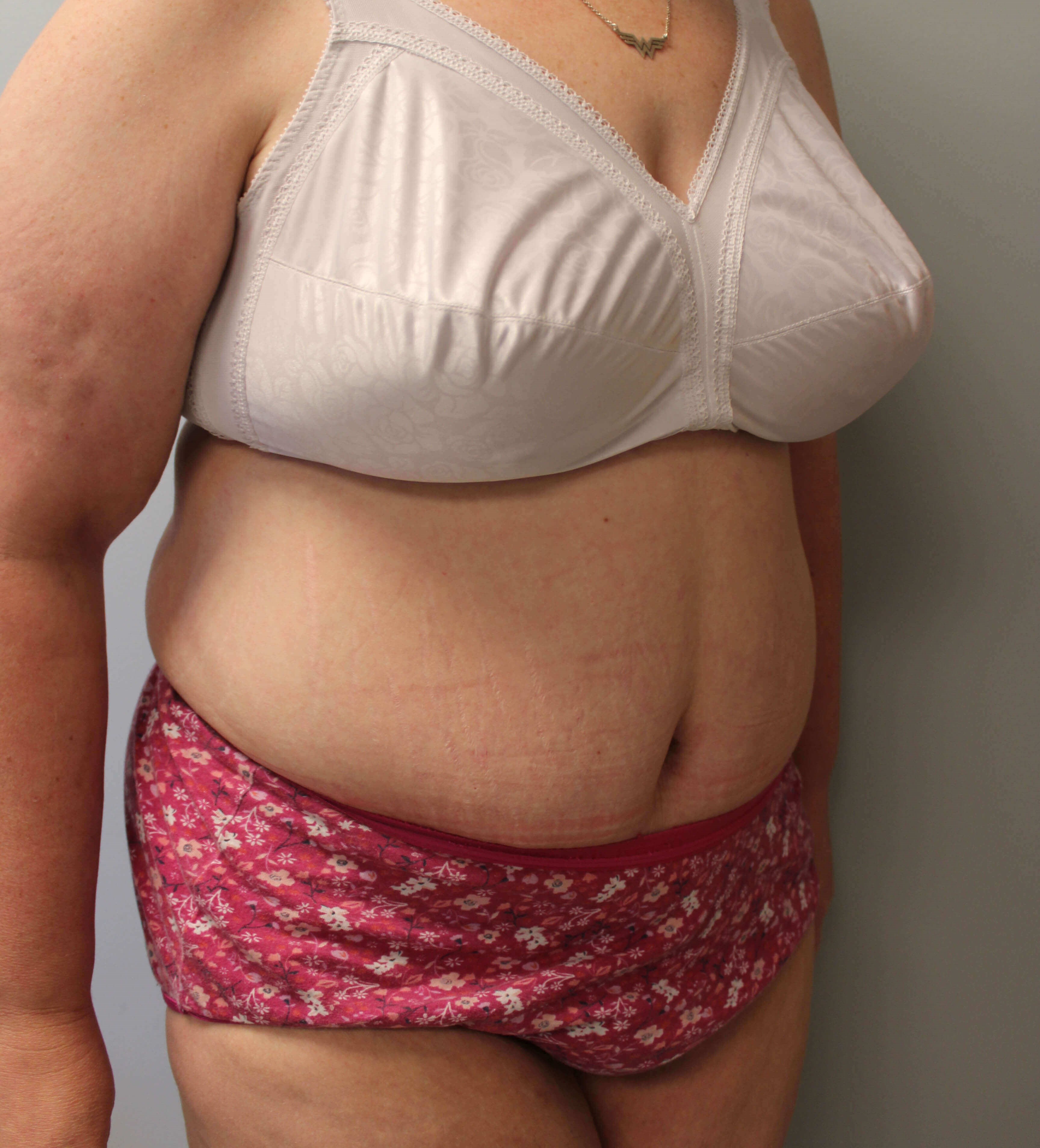 Tummy Tuck after weight loss Before