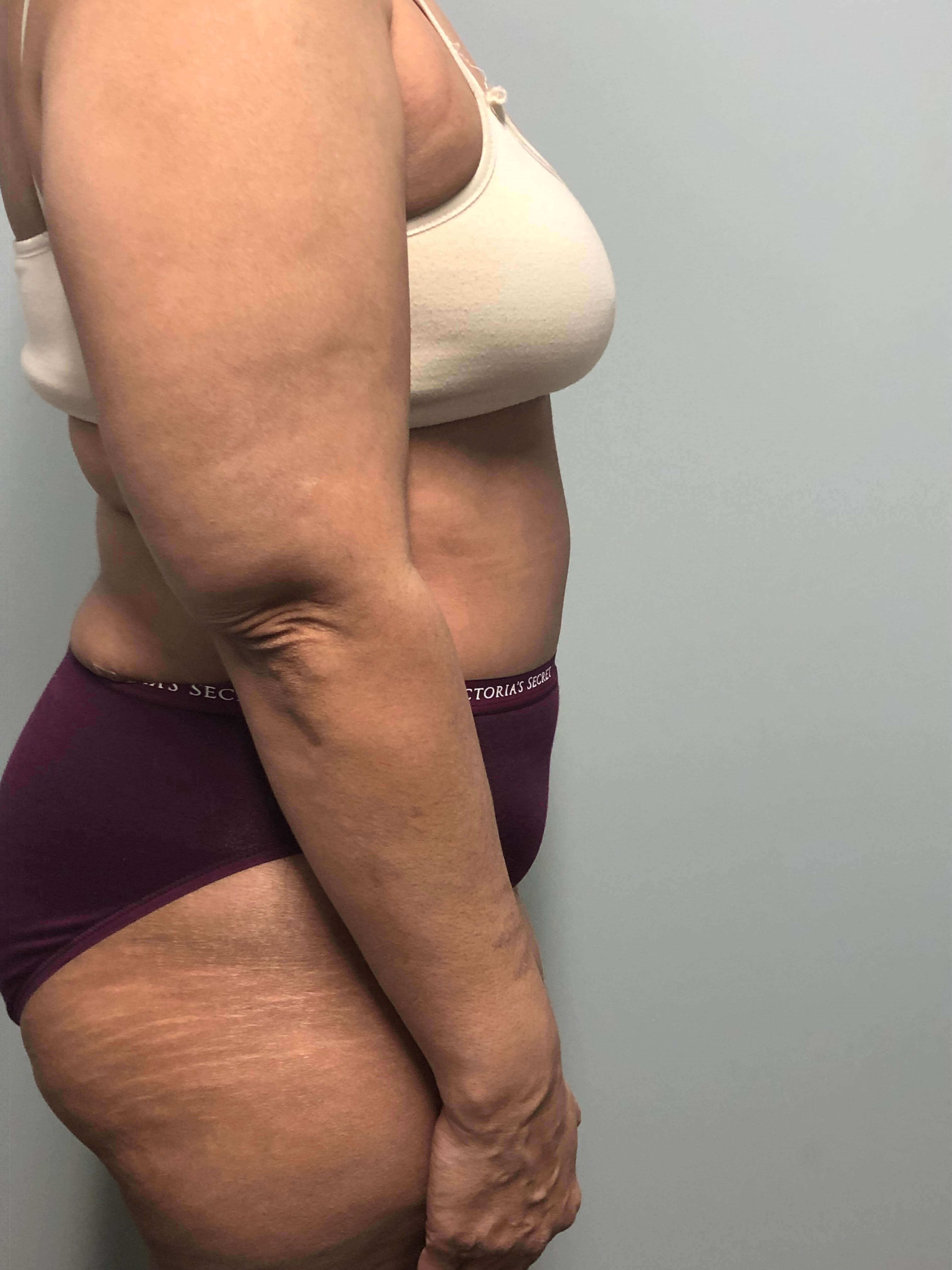 Tummy Tuck Surgery After