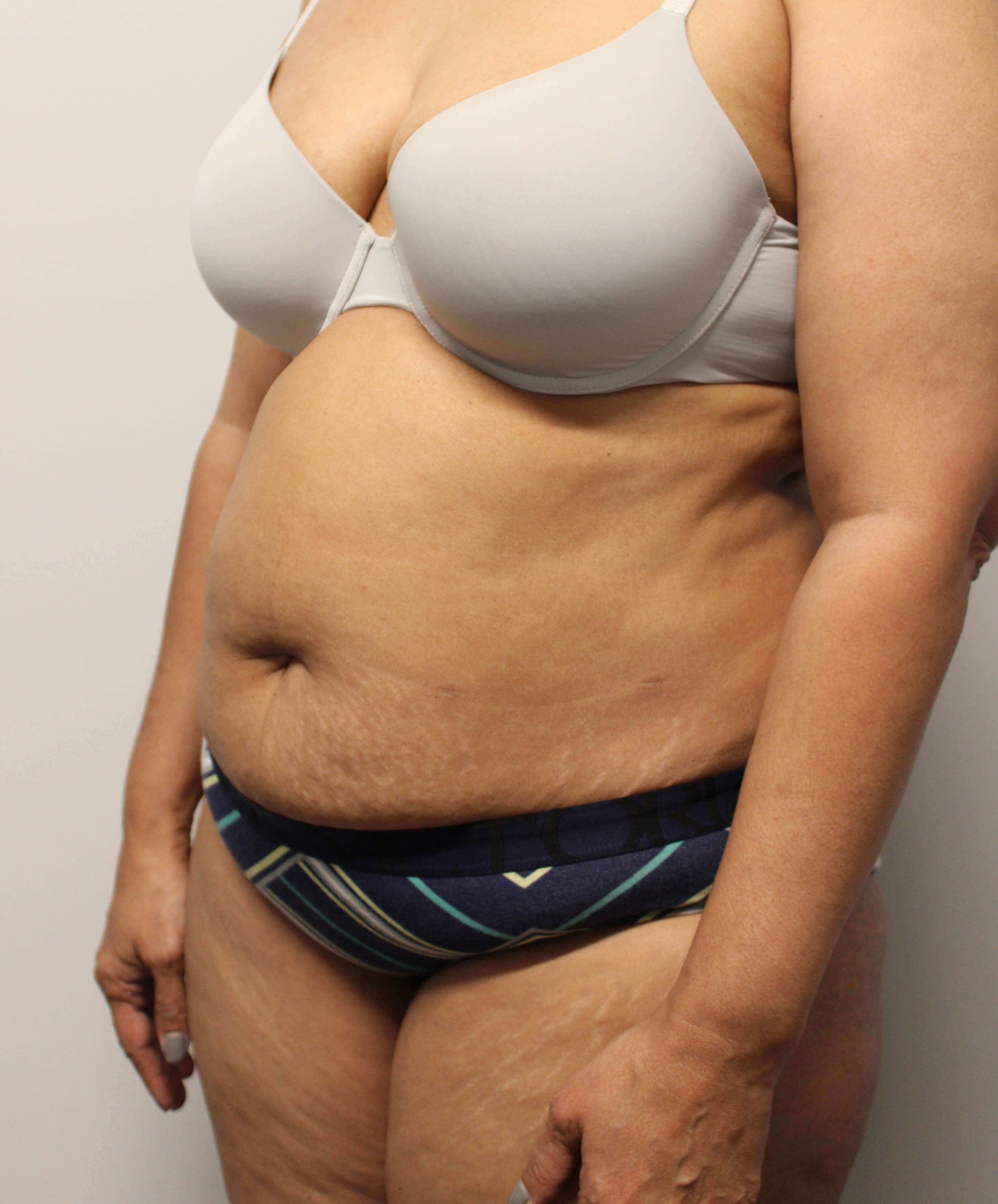 Tummy Tuck Surgery Before