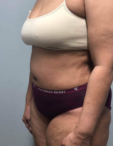 Tummy Tuck Surgery After