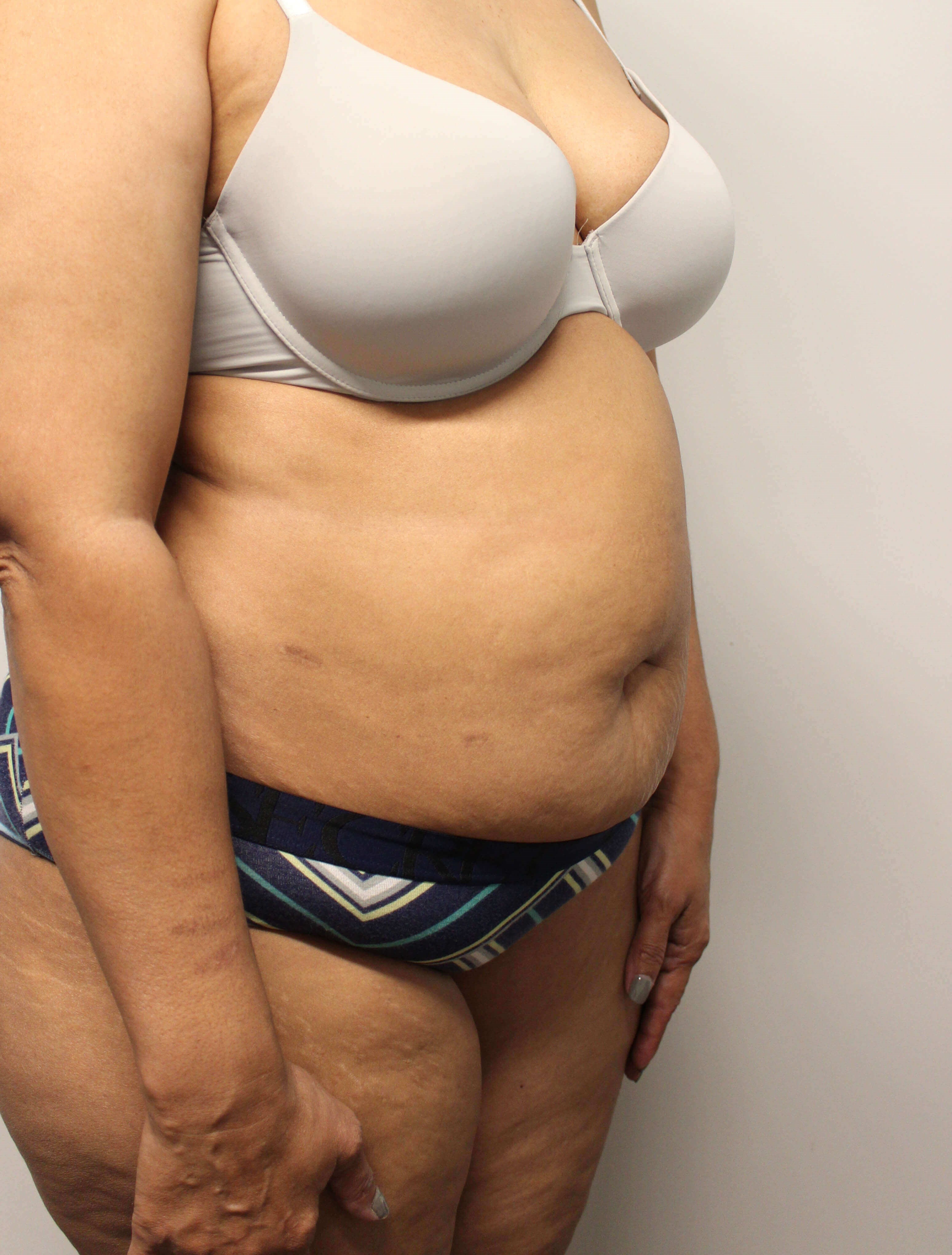 Tummy Tuck Surgery Before
