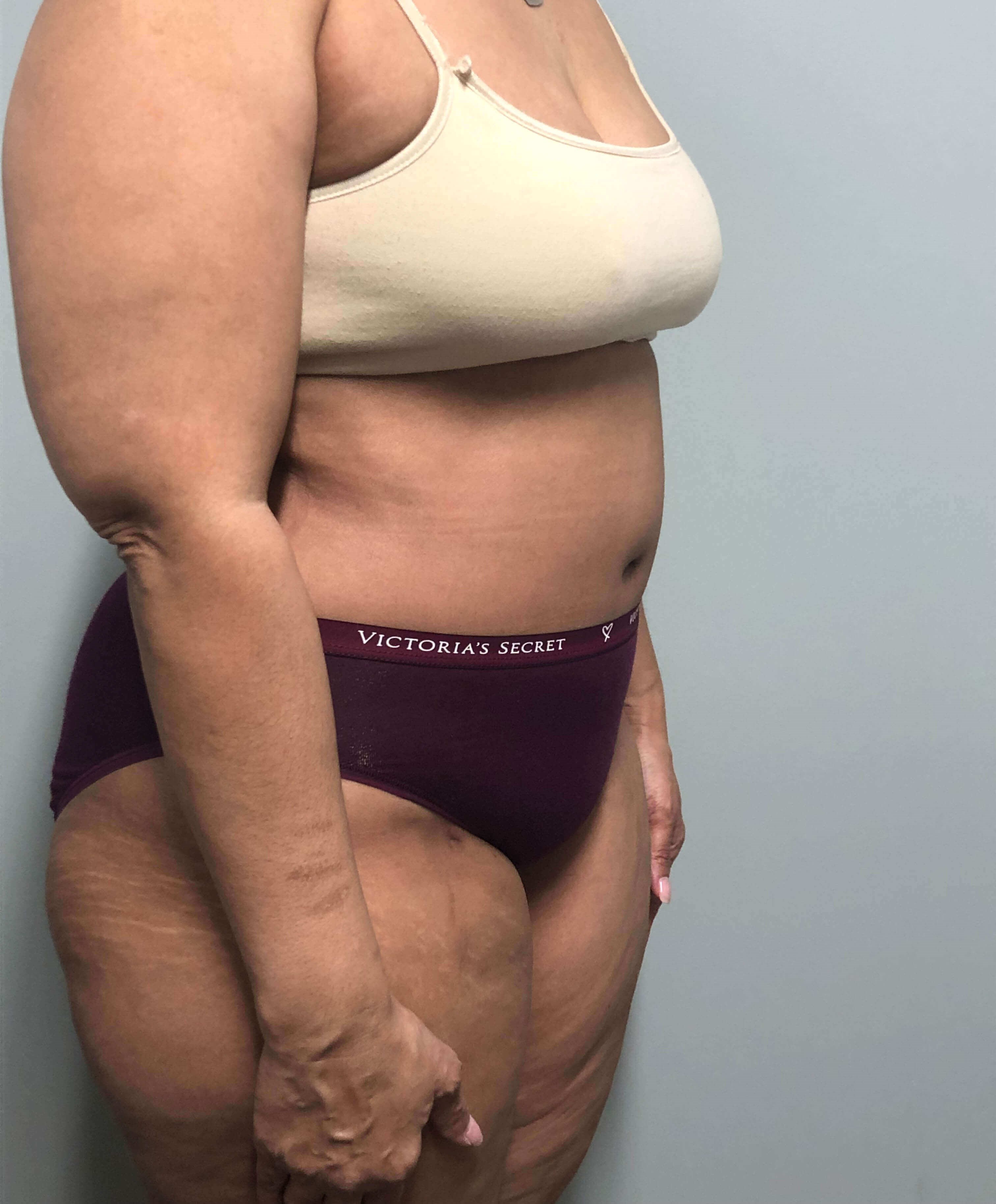 Tummy Tuck Surgery After