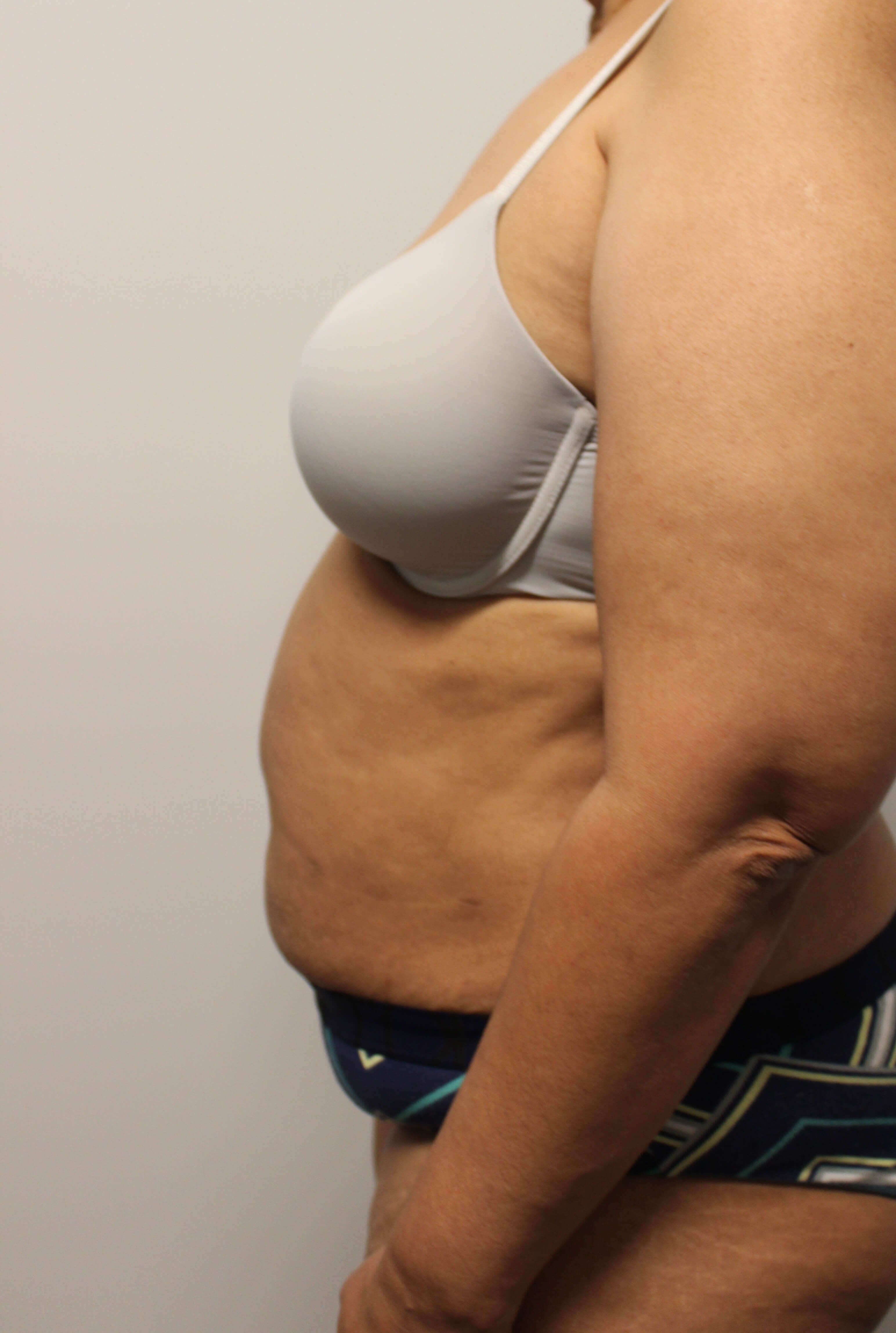 Tummy Tuck Surgery Before