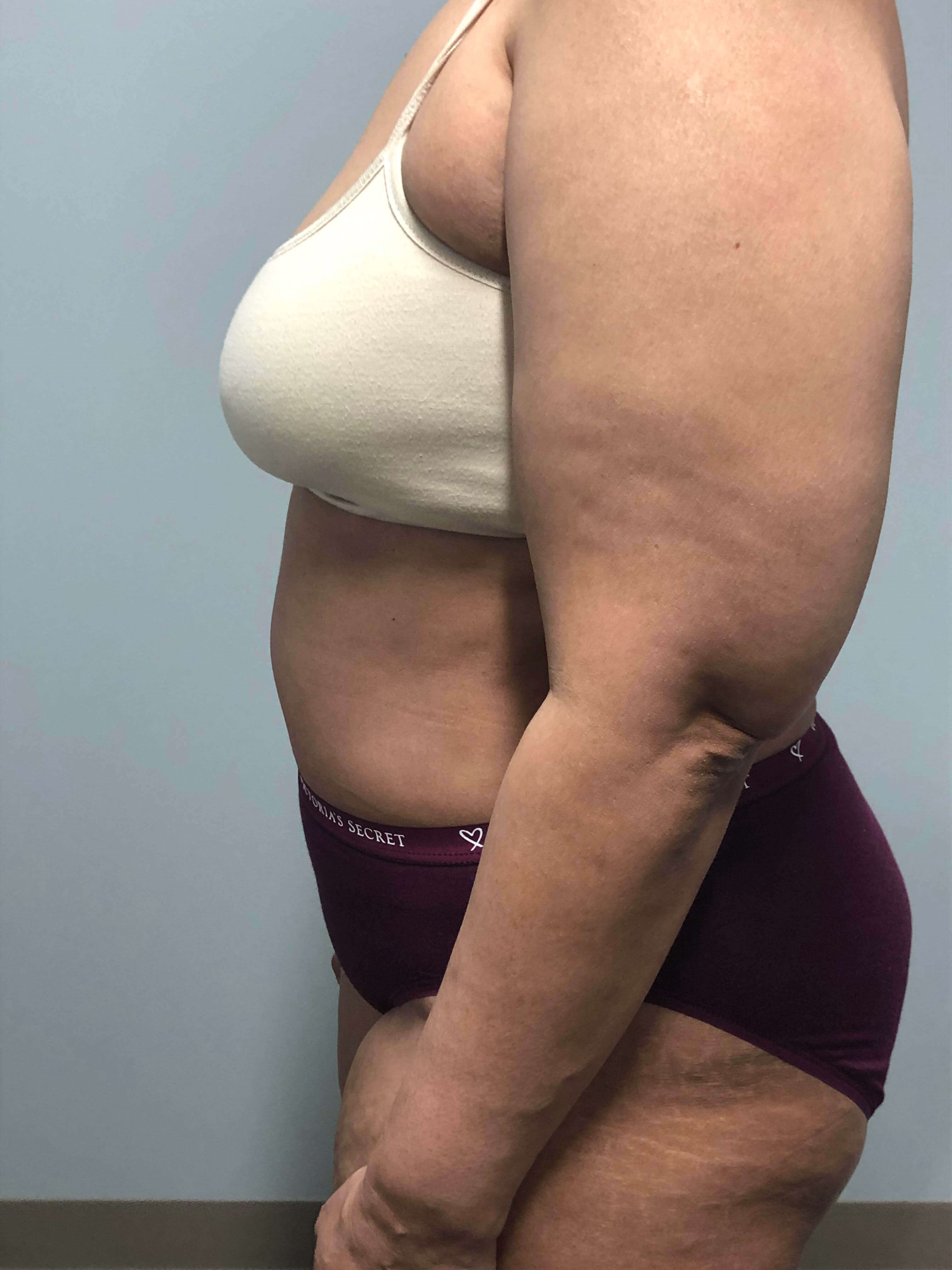 Tummy Tuck Surgery After