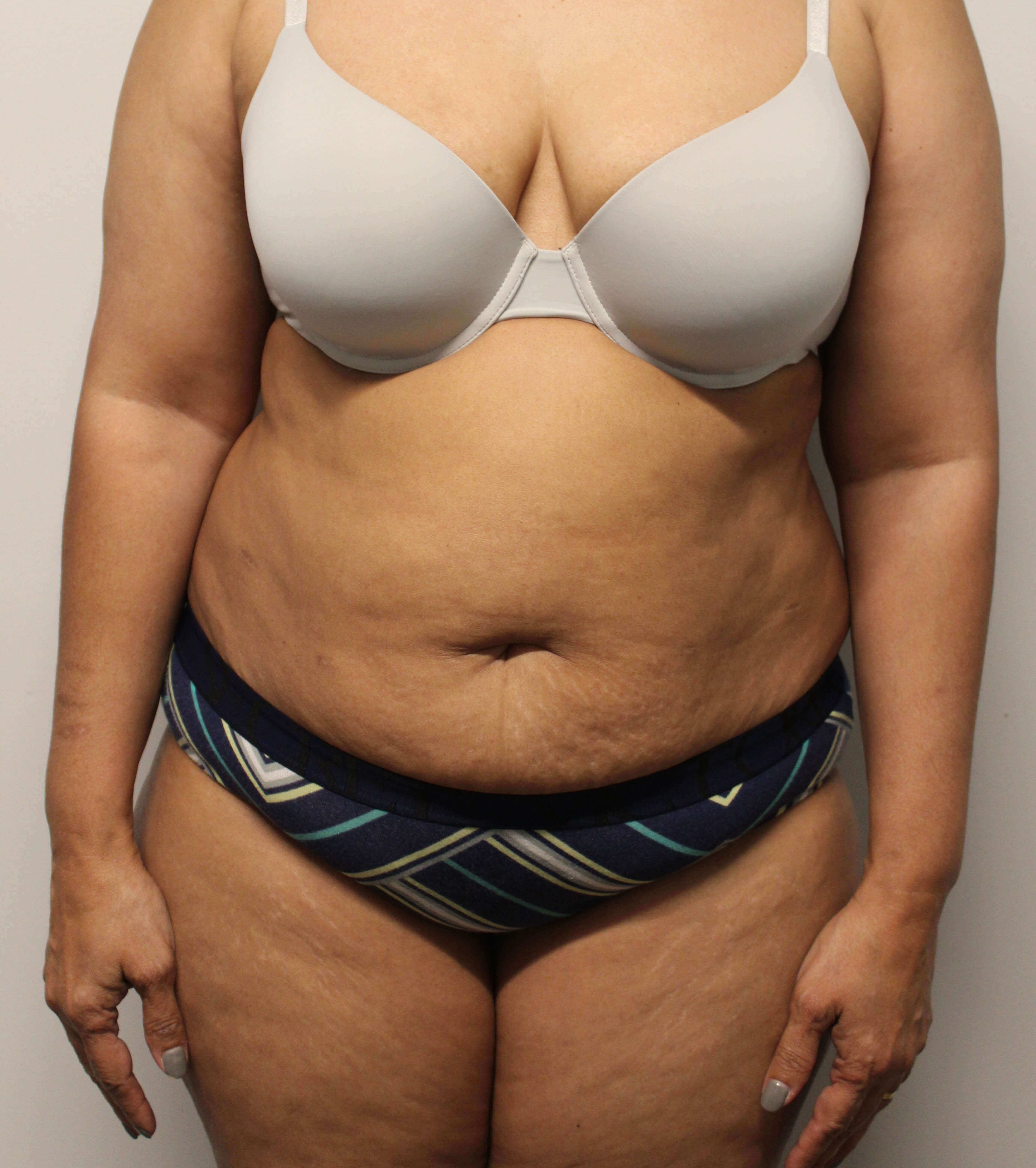 Tummy Tuck Surgery Before