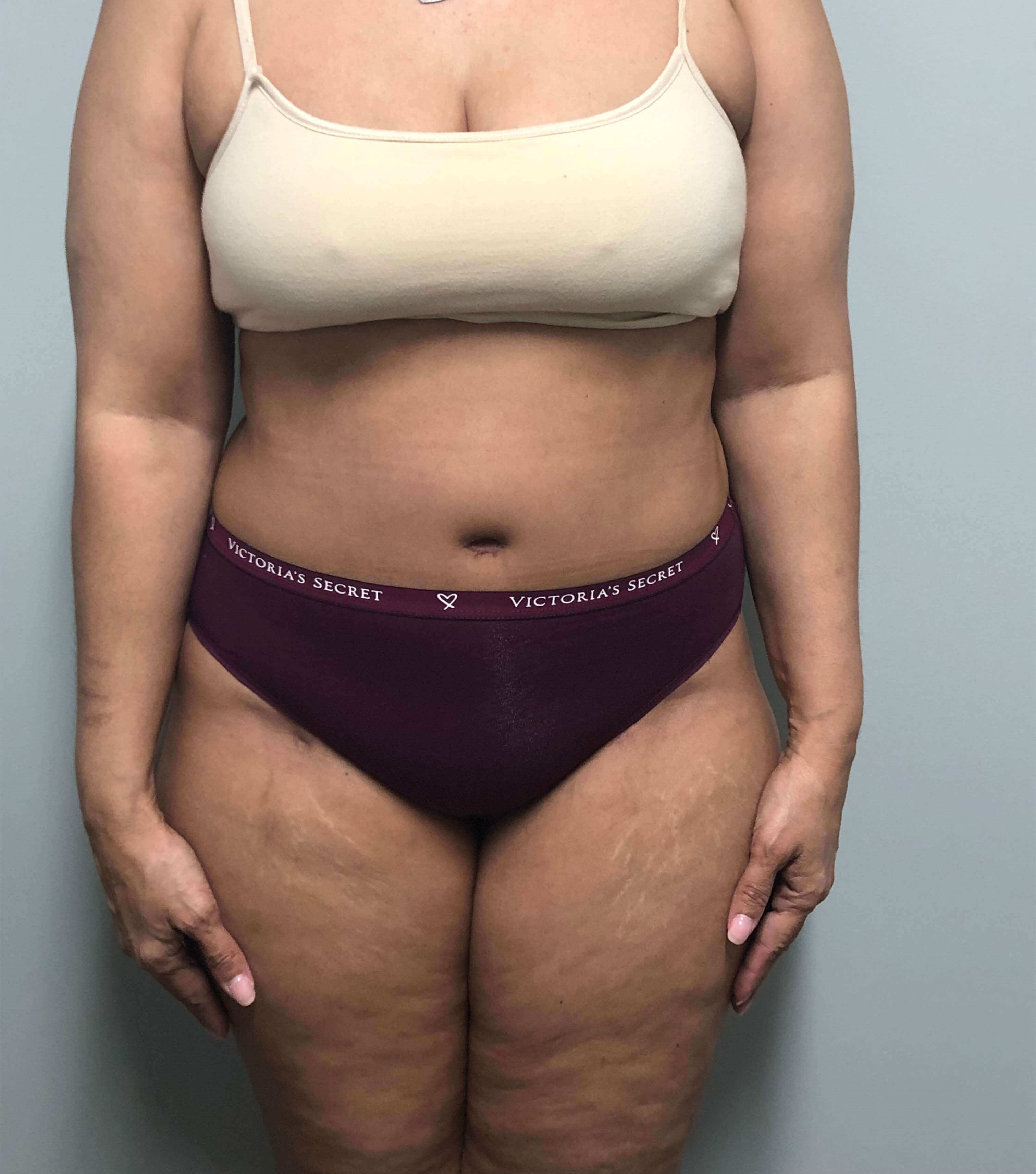 Tummy Tuck Surgery After