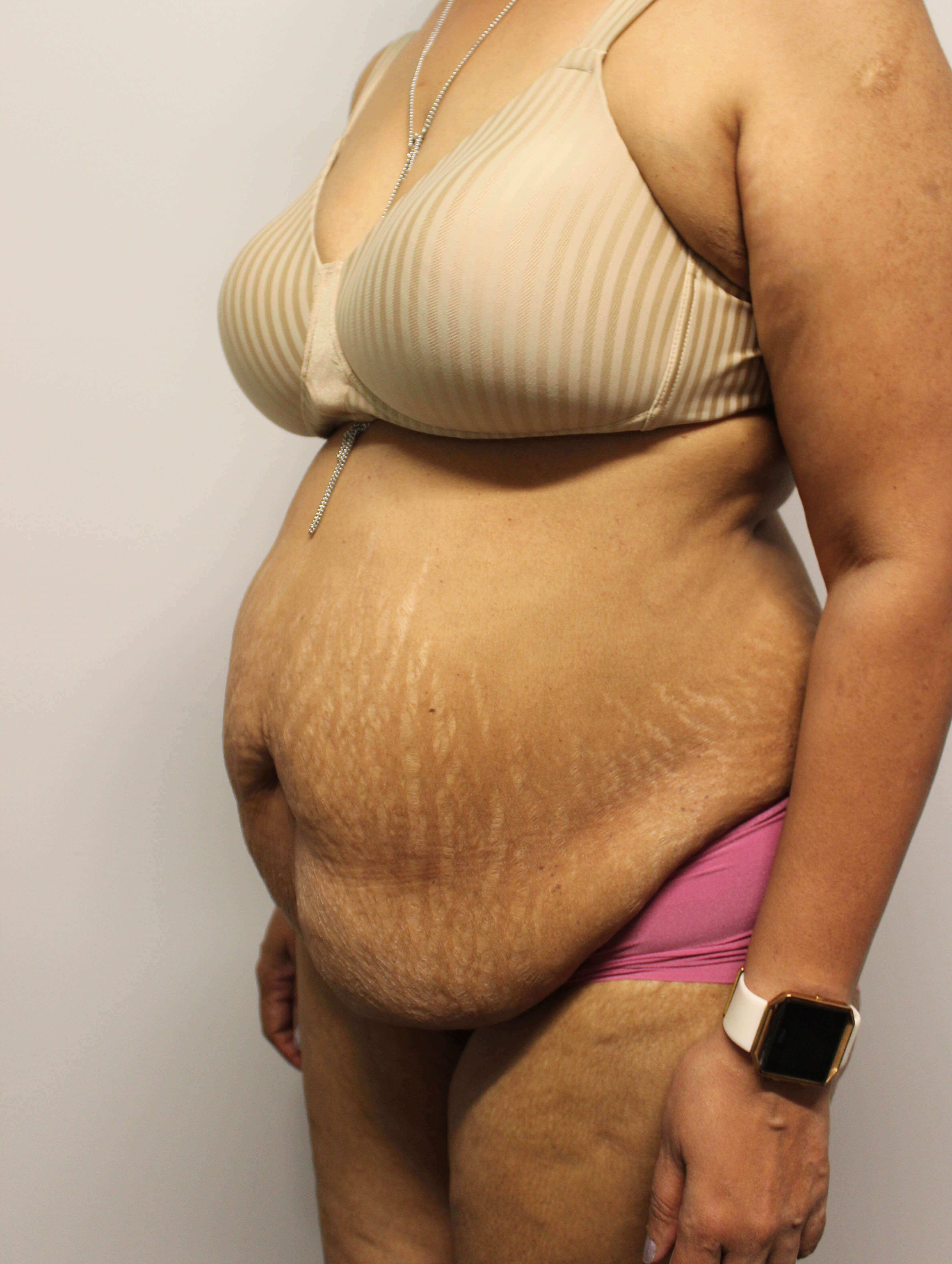 Abdominoplasty Surgery Before