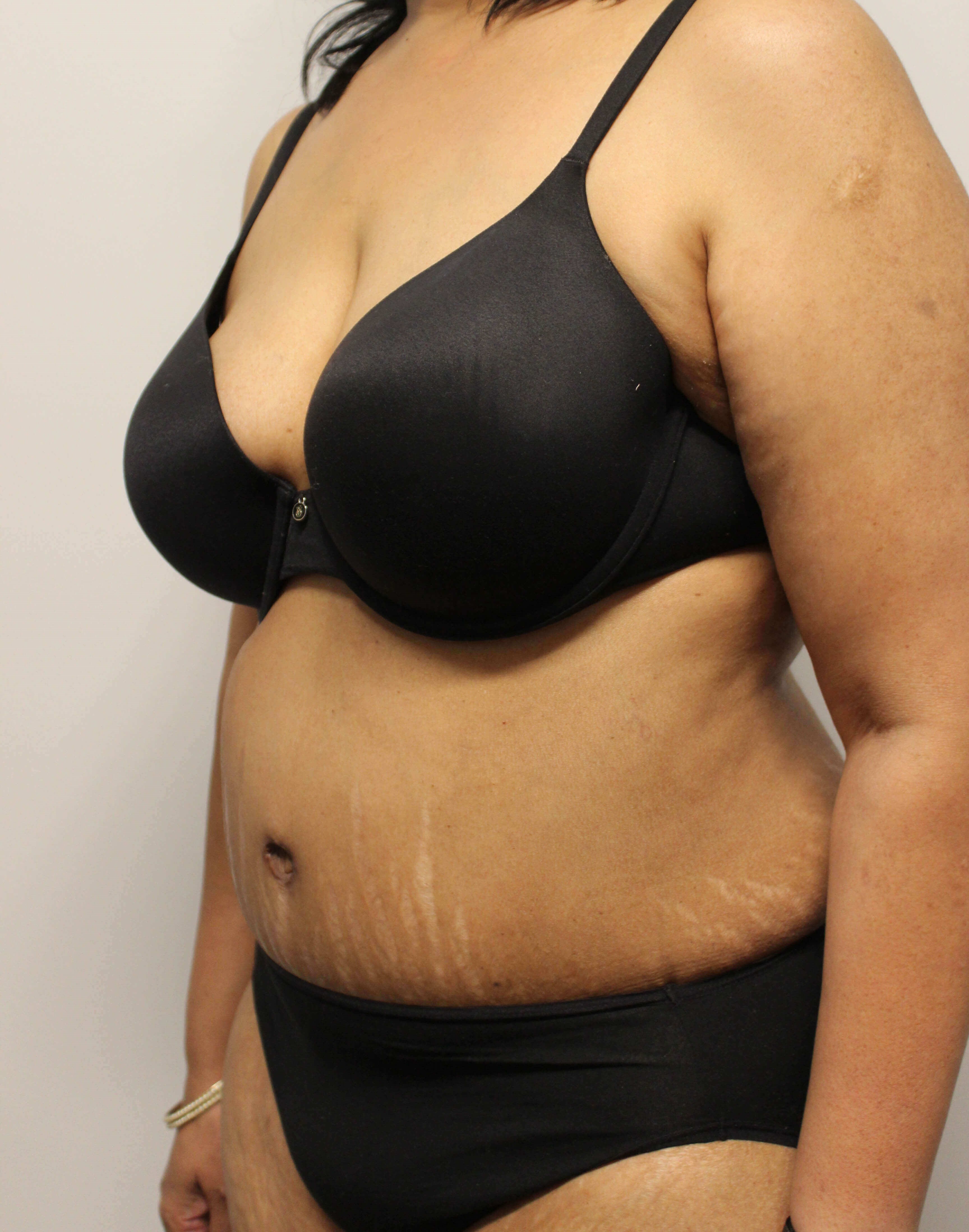 Abdominoplasty Surgery After