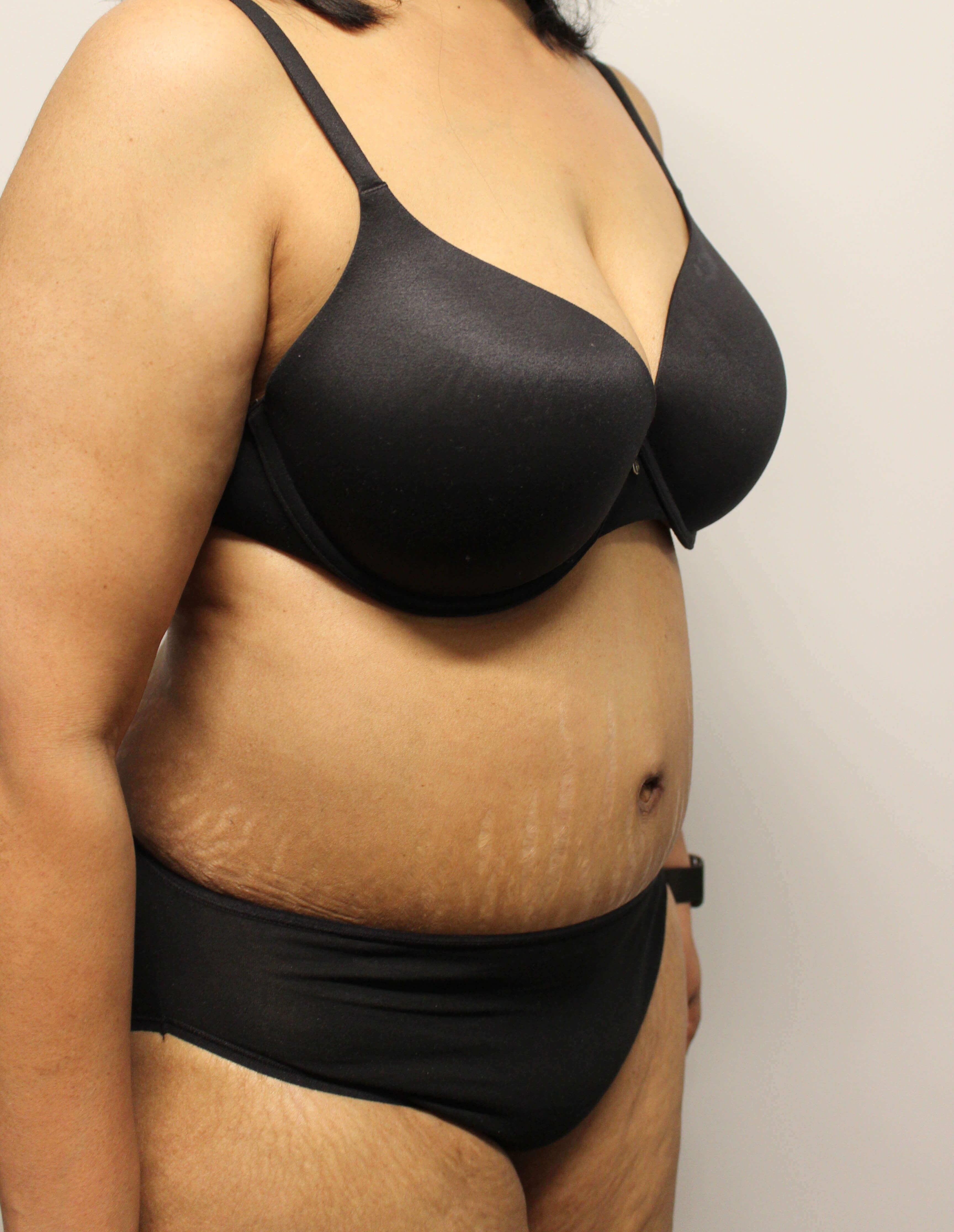 Abdominoplasty Surgery After