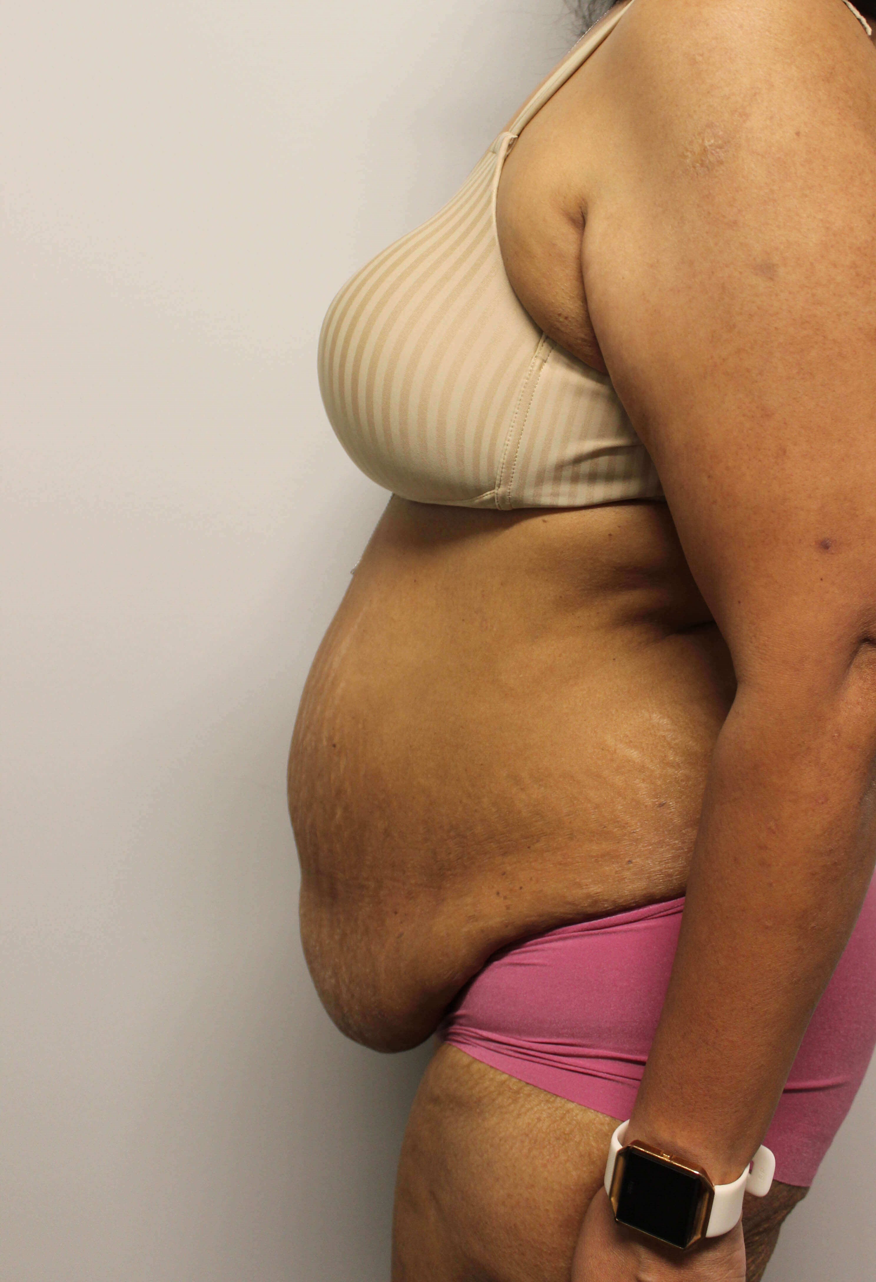 Abdominoplasty Surgery Before
