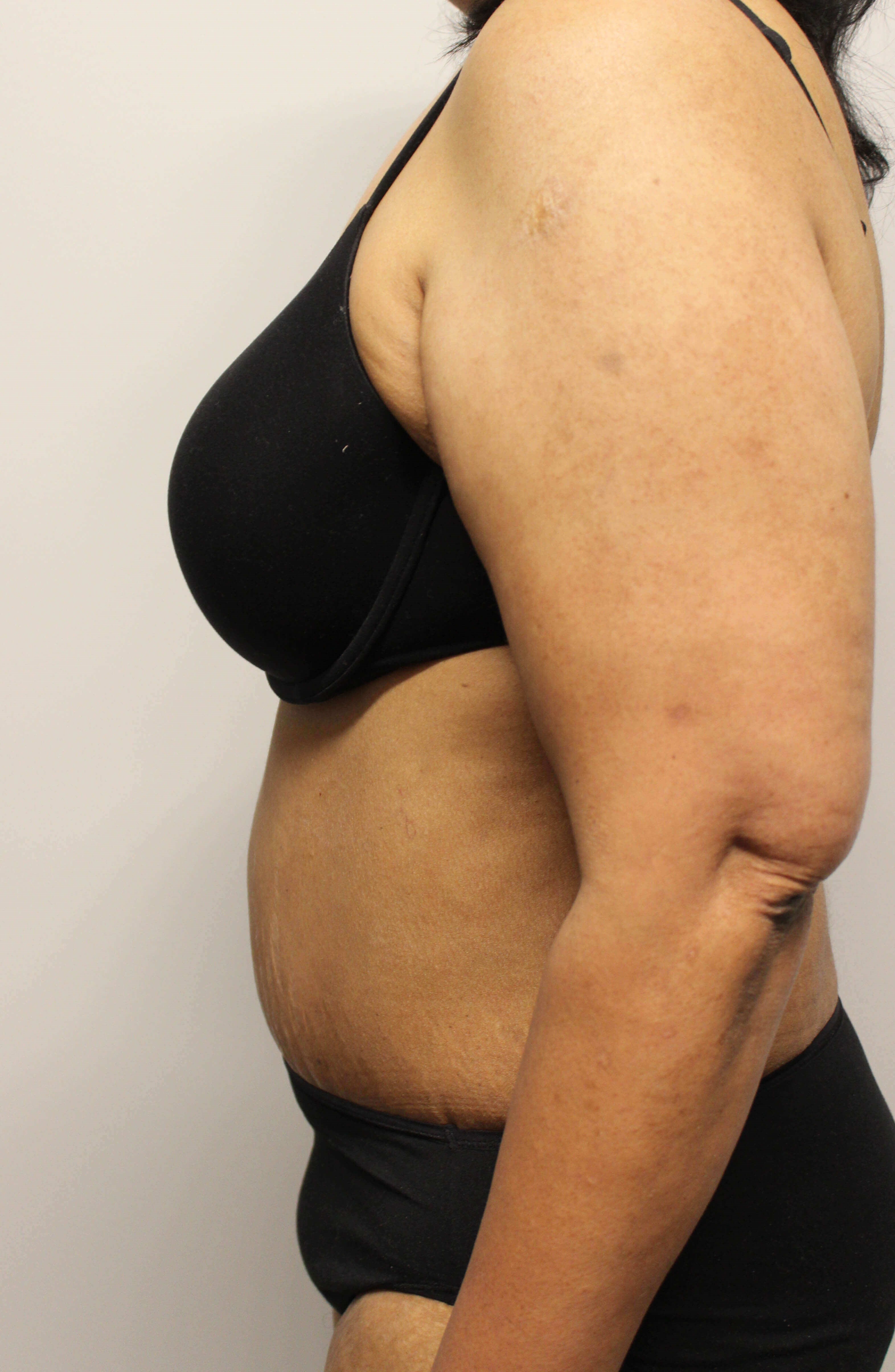 Abdominoplasty Surgery After