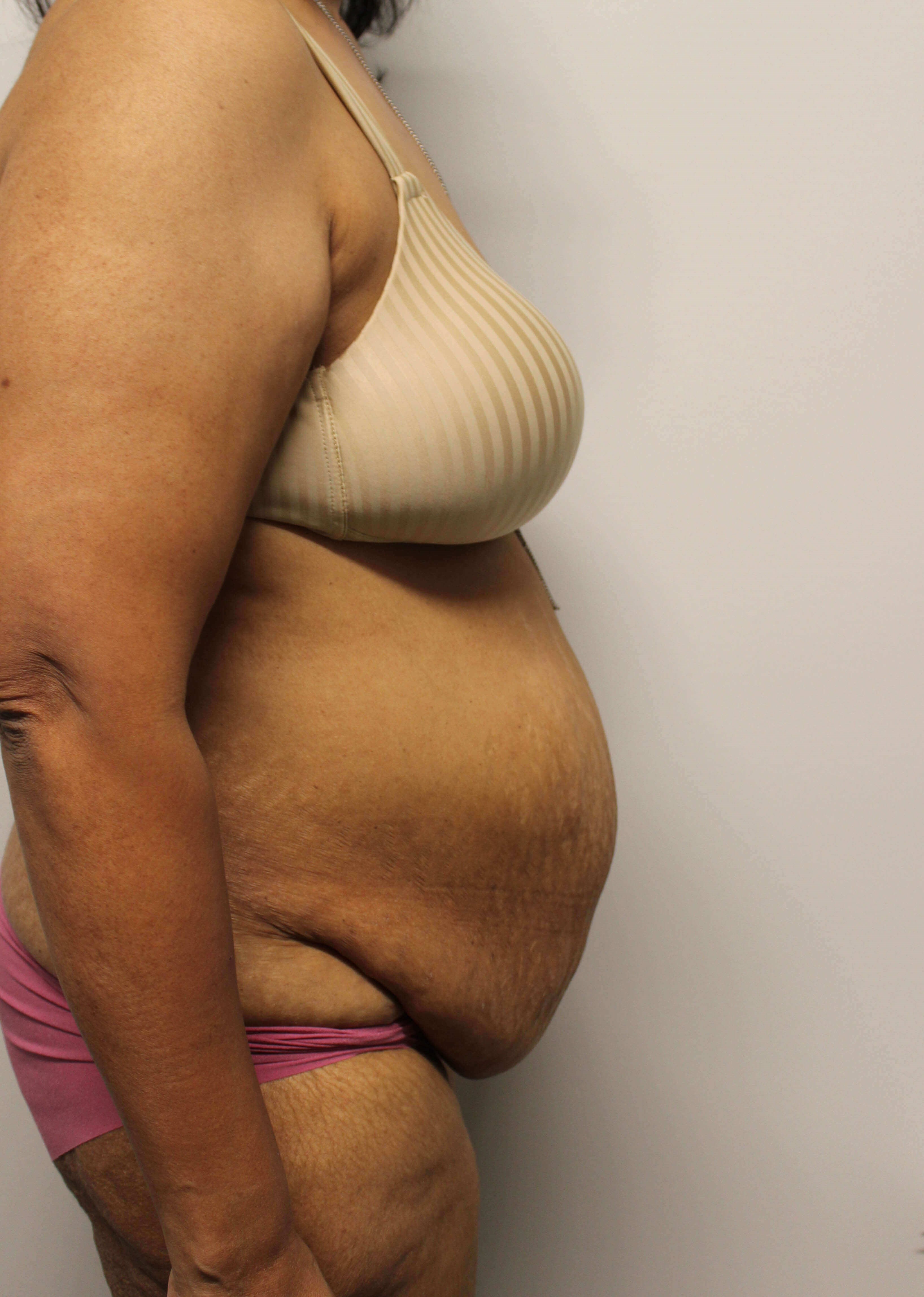 Abdominoplasty Surgery Before