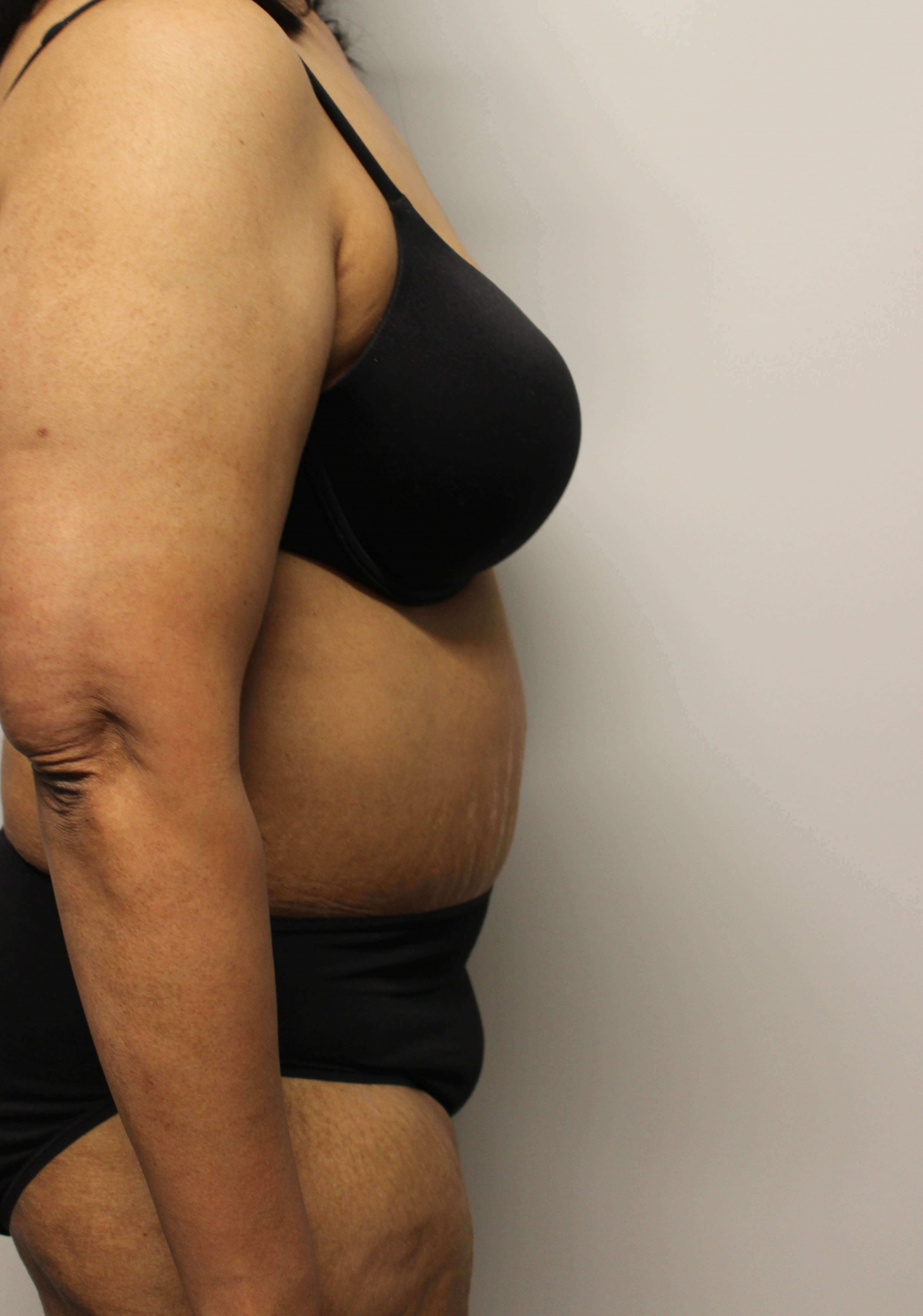 Abdominoplasty Surgery After