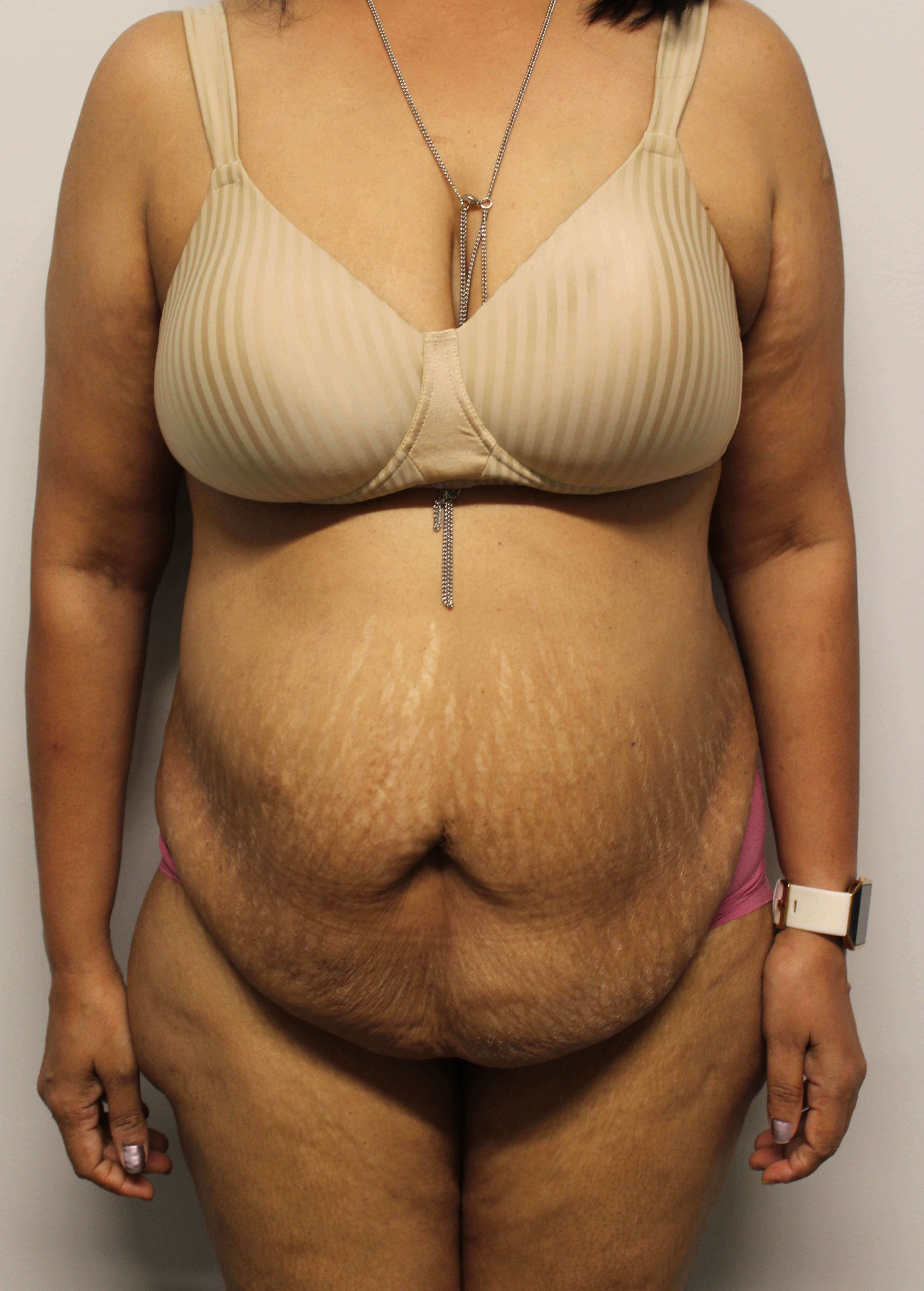 Abdominoplasty Surgery Before