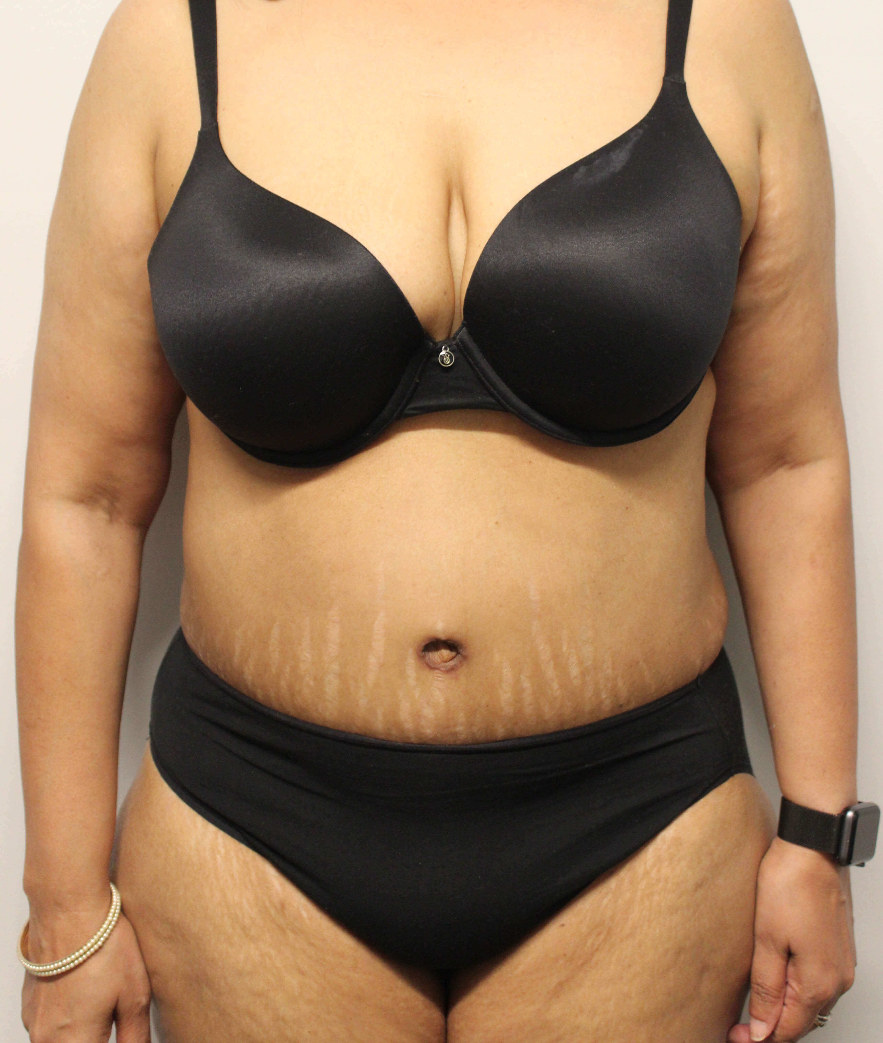 Abdominoplasty Surgery After