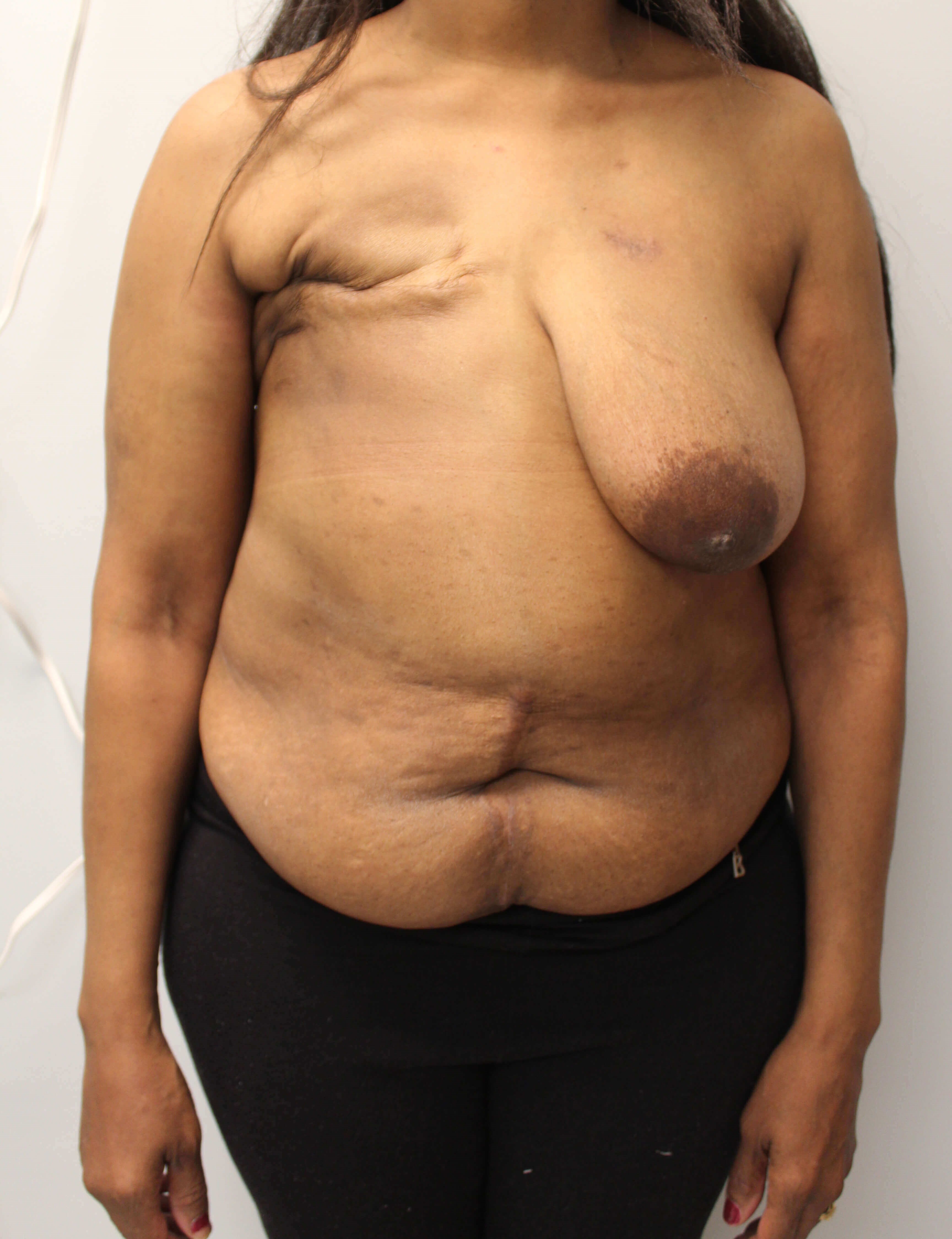 Delayed Breast DIEP Flaps Before