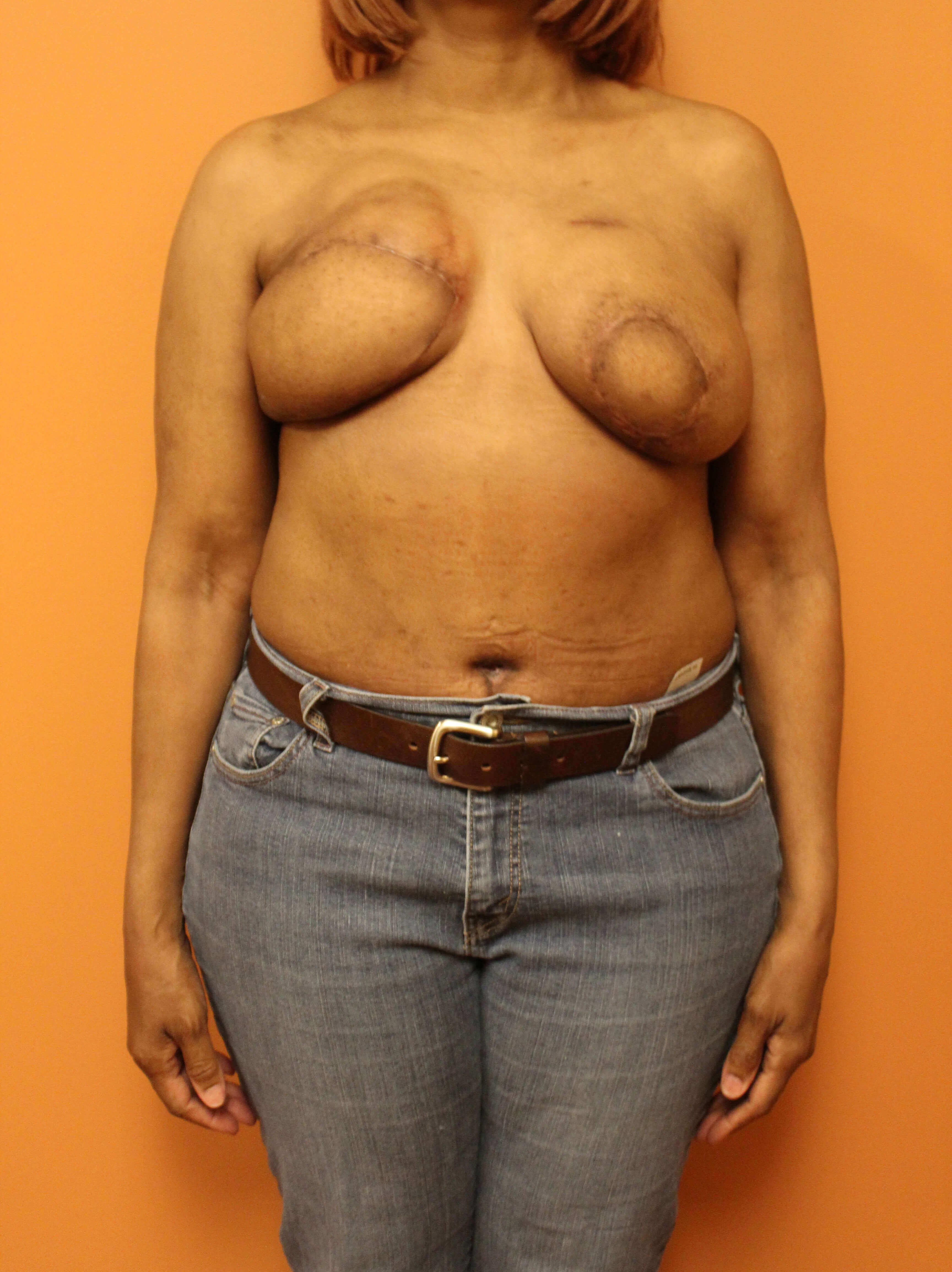 Delayed Breast DIEP Flaps After