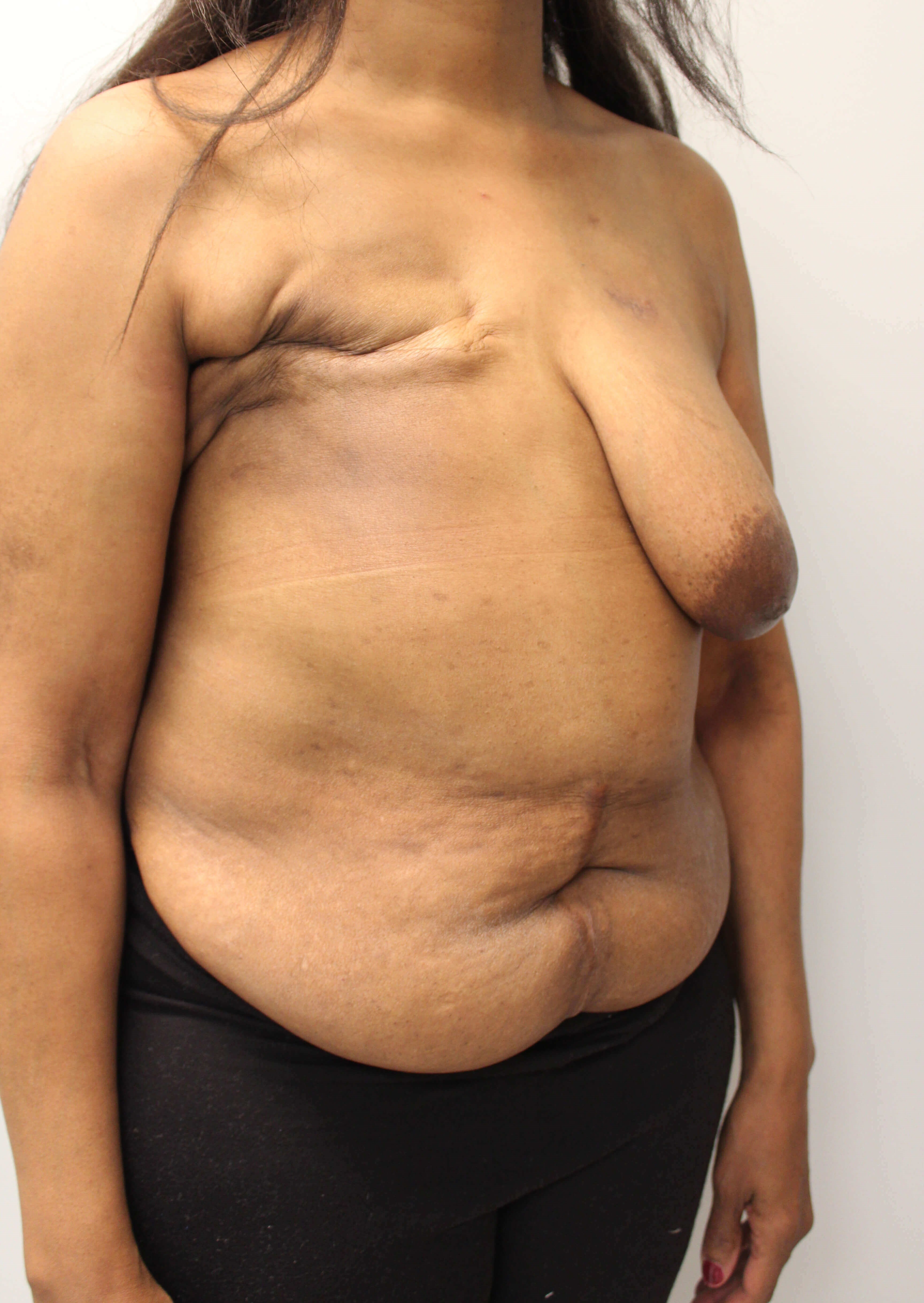 Delayed Breast DIEP Flaps Before