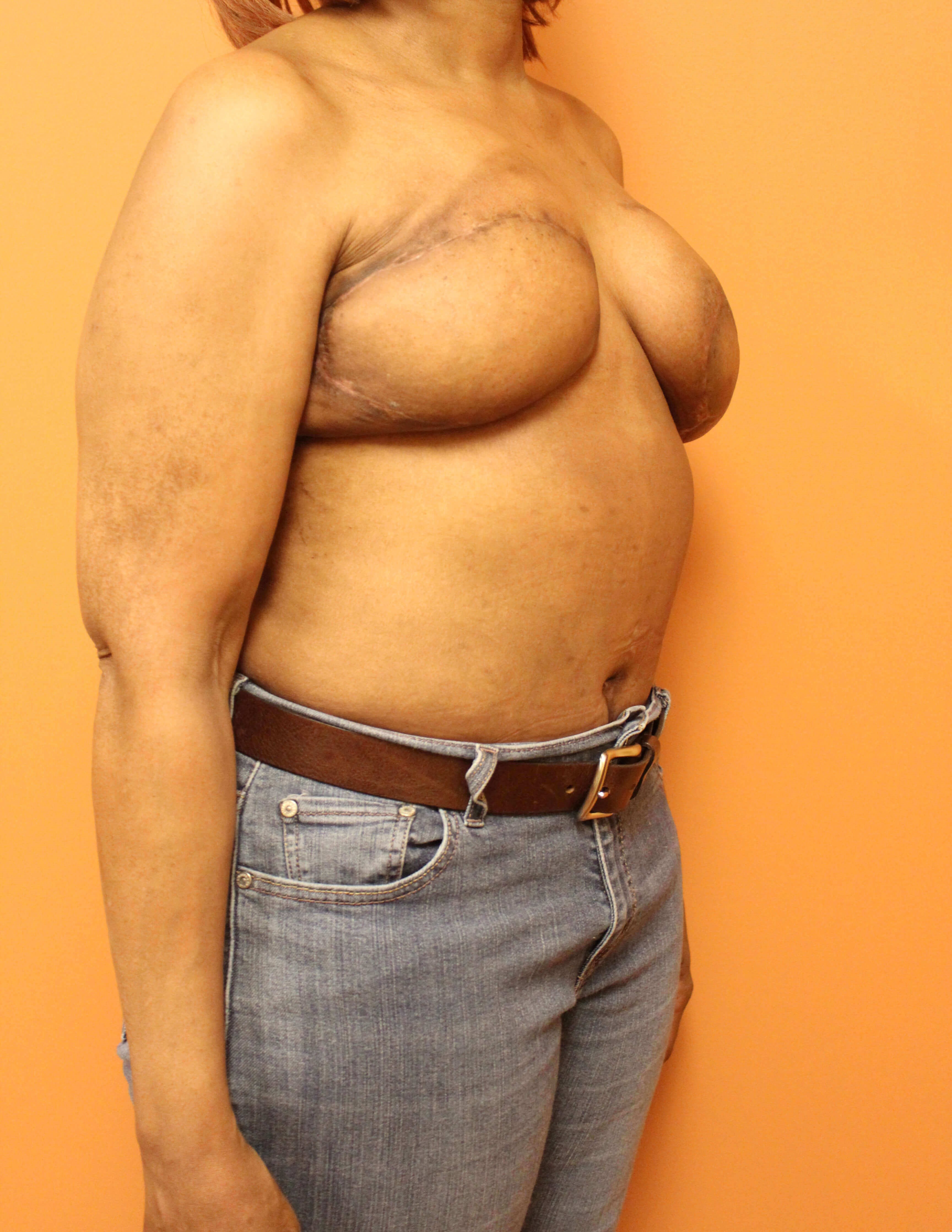 Delayed Breast DIEP Flaps After