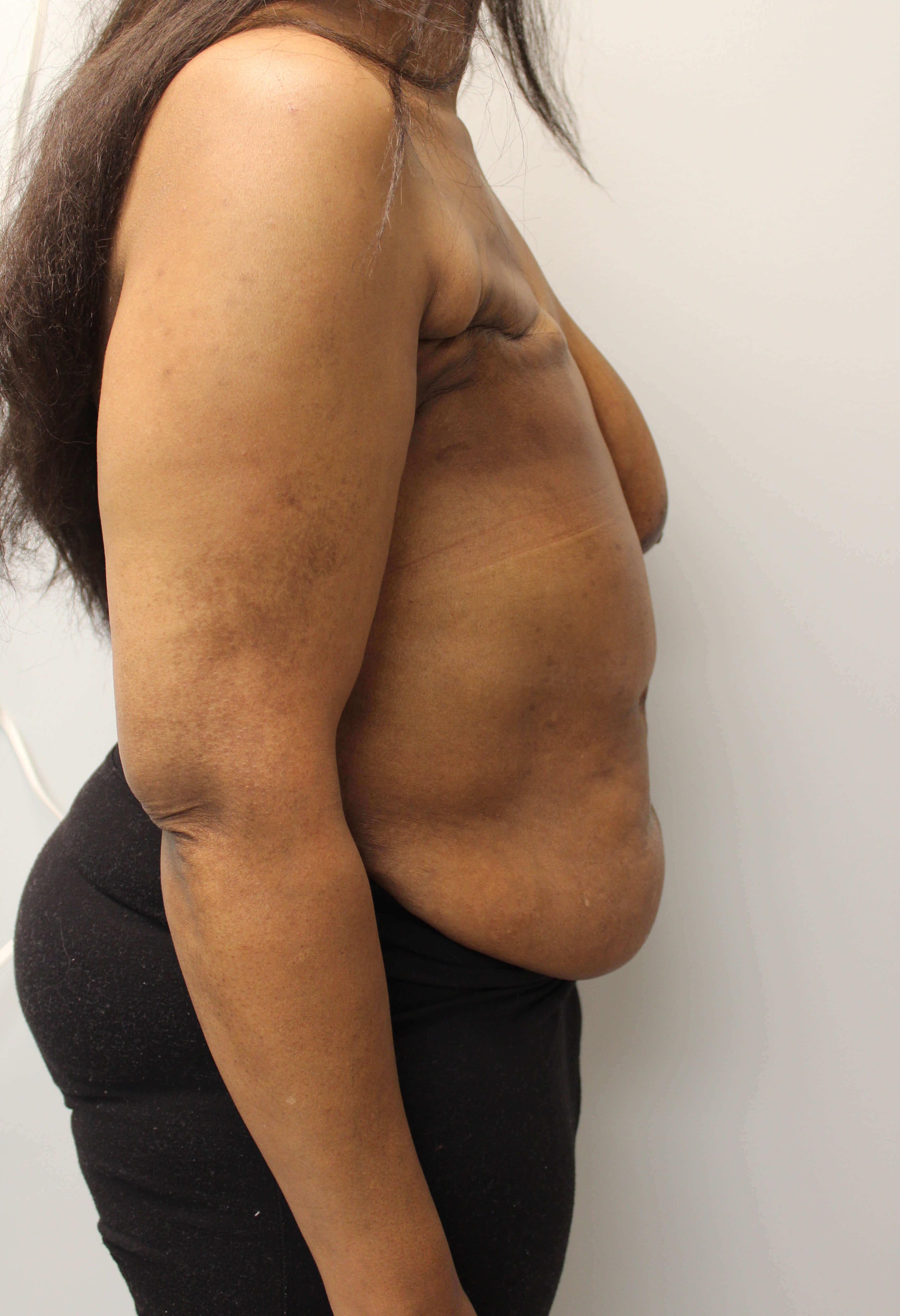 Delayed Breast DIEP Flaps Before