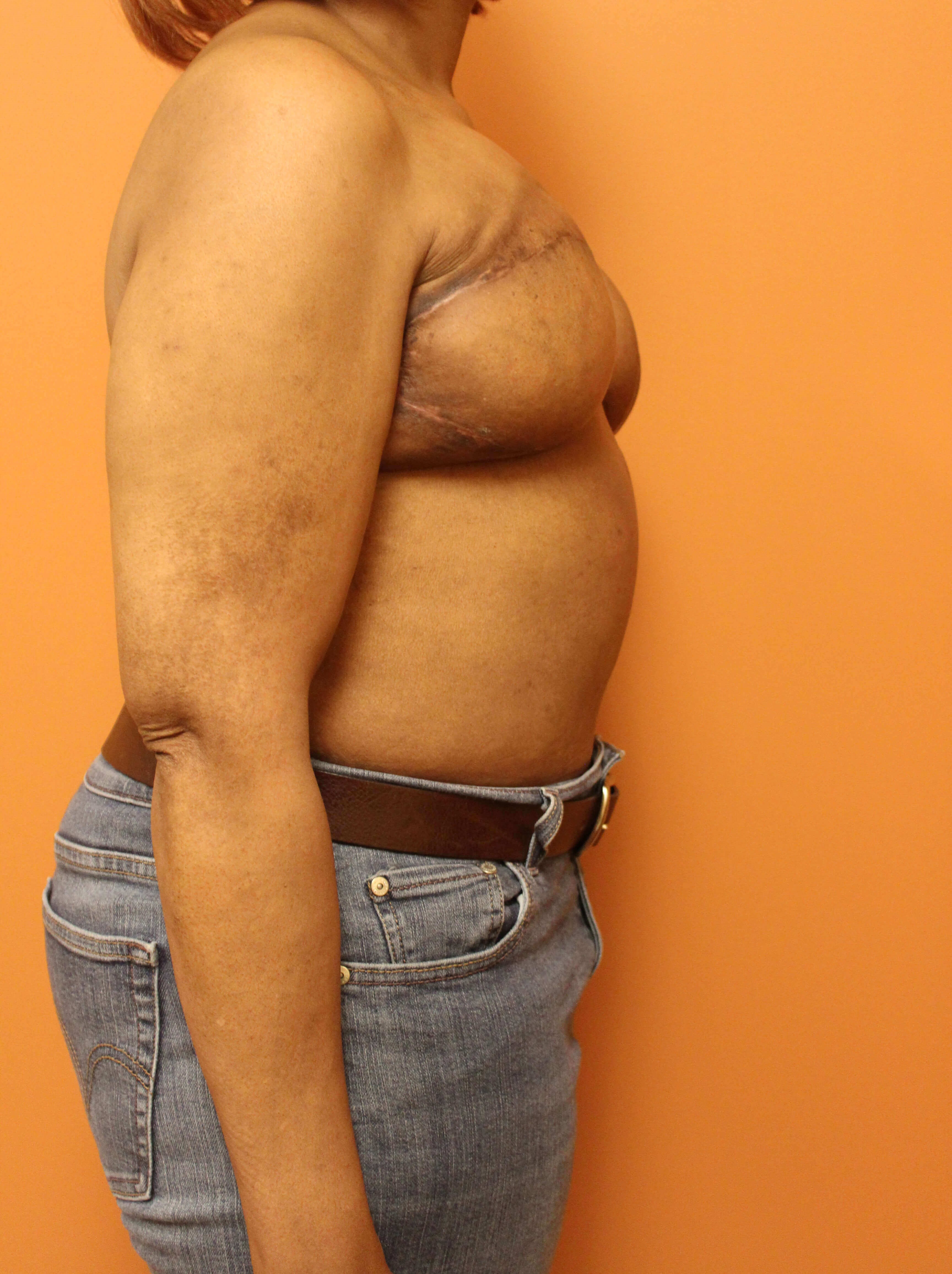 Delayed Breast DIEP Flaps After