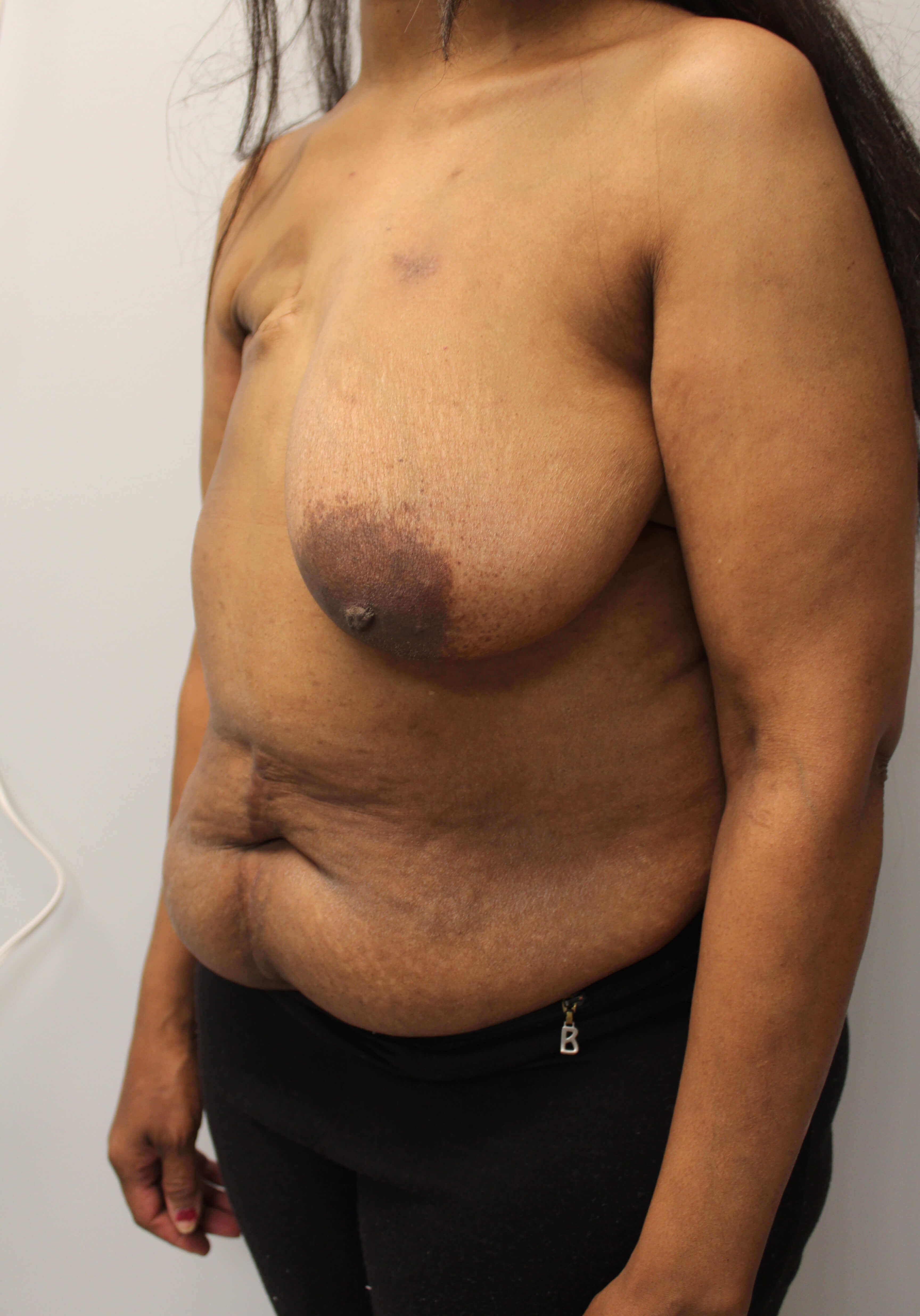Delayed Breast DIEP Flaps Before