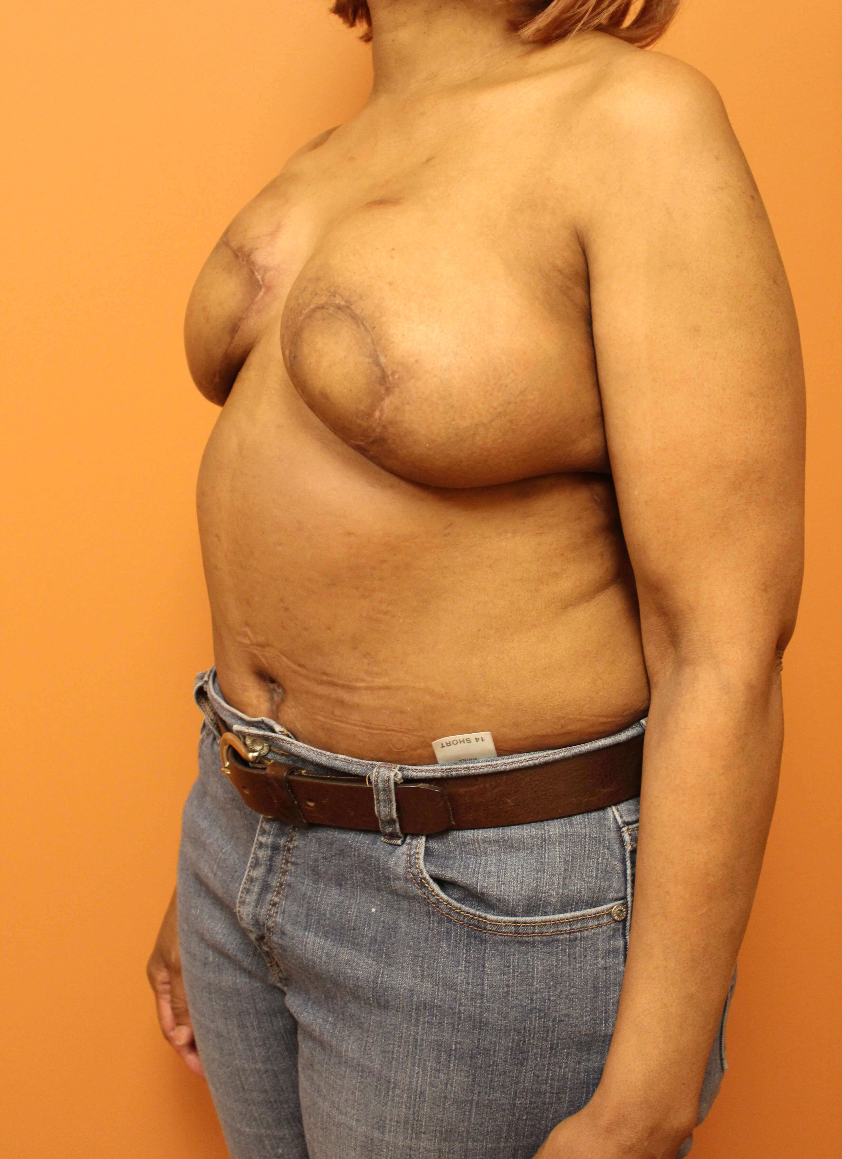 Delayed Breast DIEP Flaps After