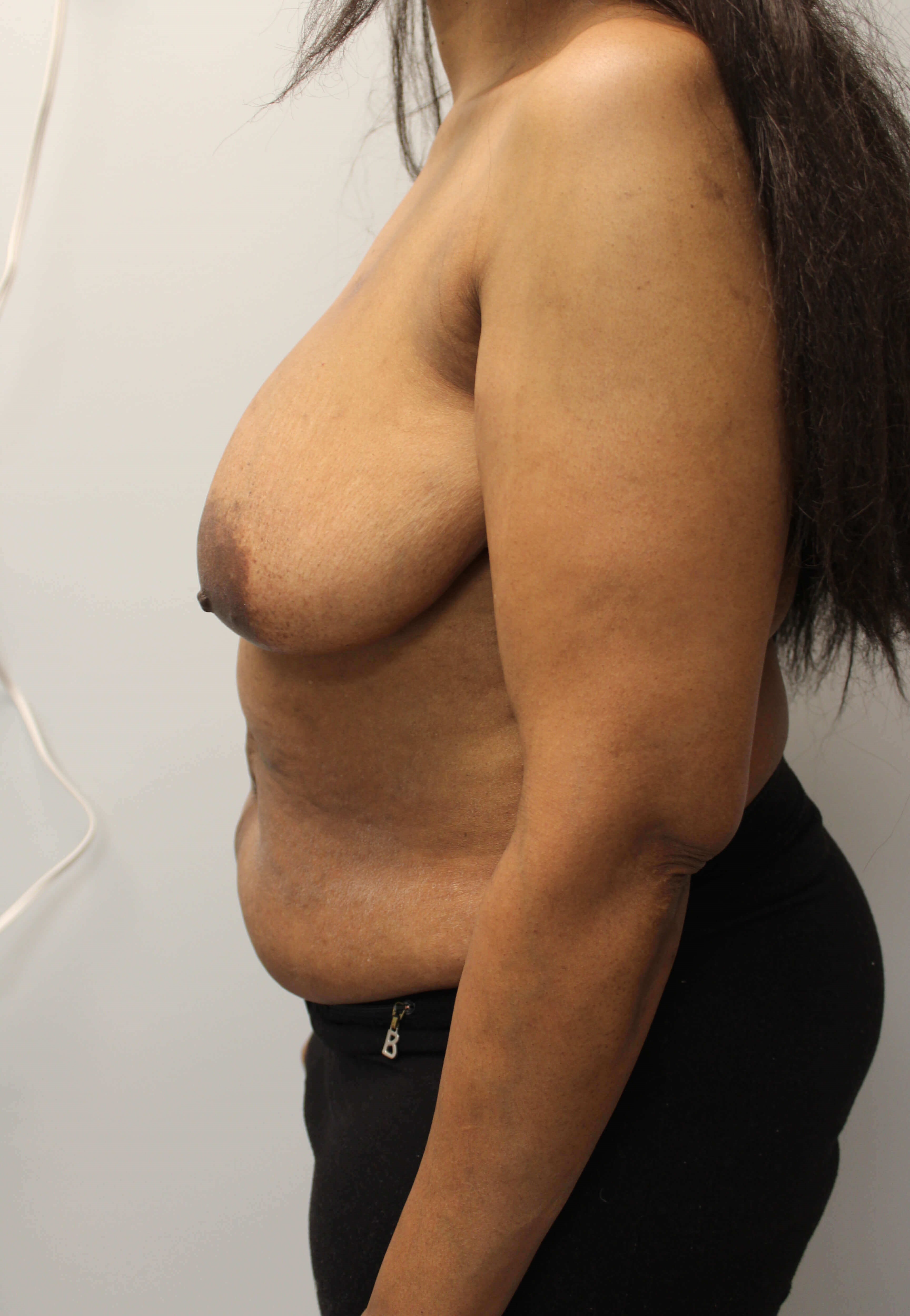 Delayed Breast DIEP Flaps Before