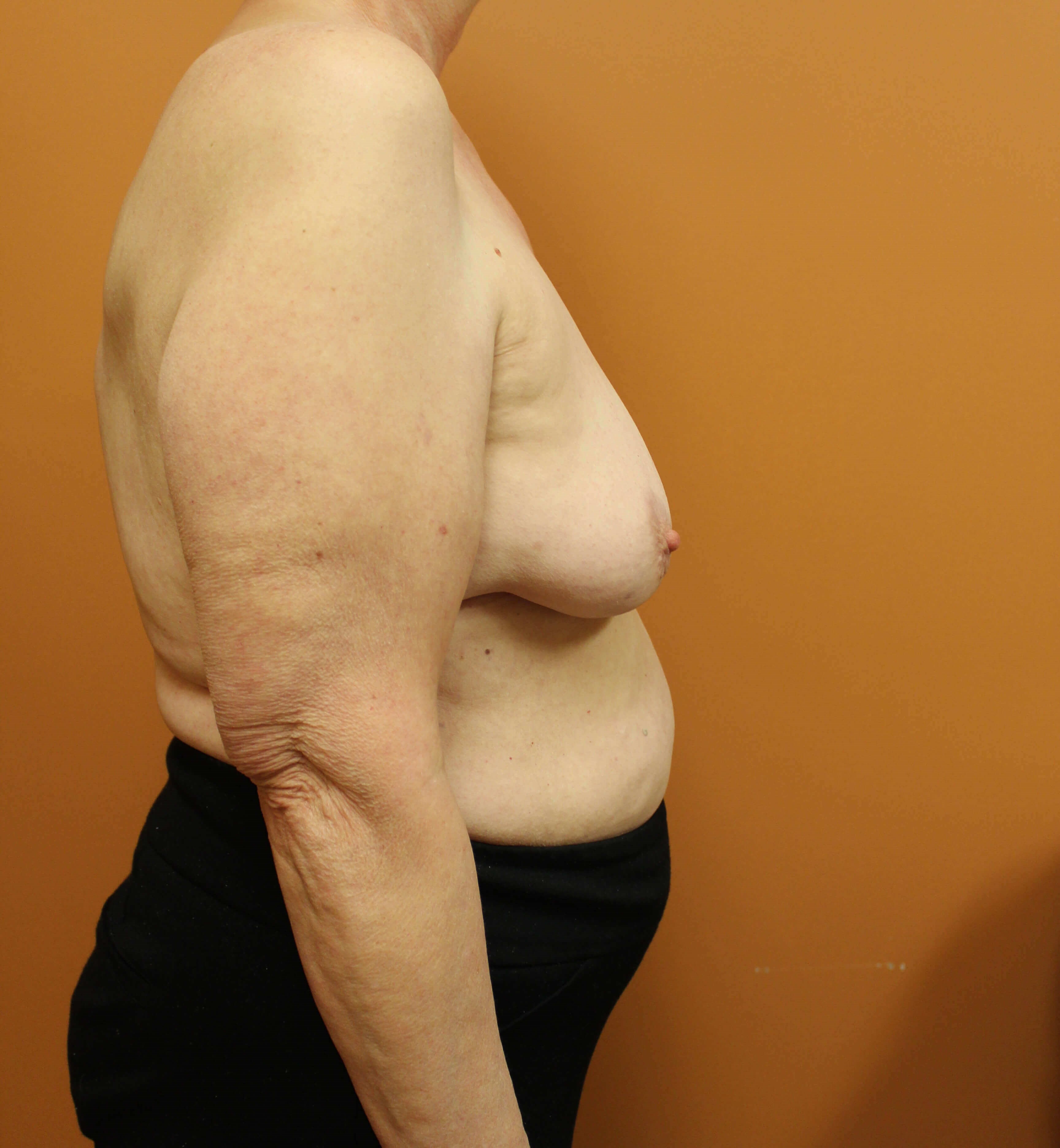 Oncoplastic Reduction Before