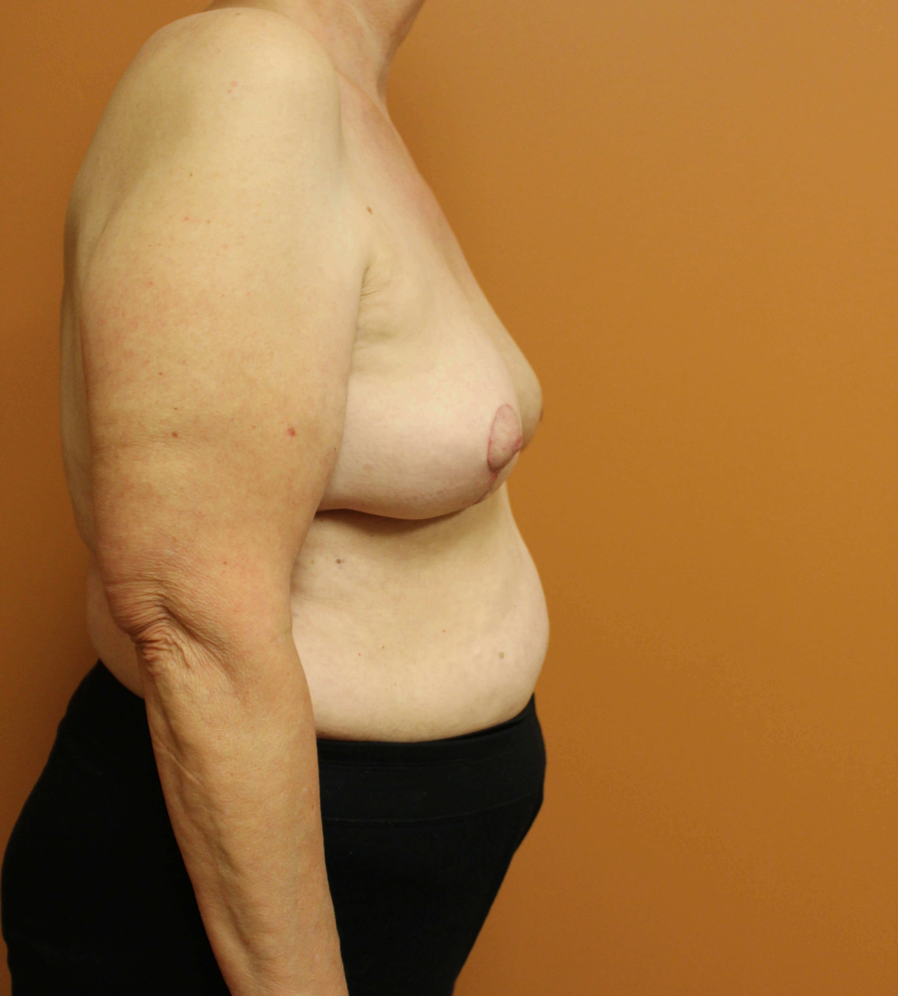 Oncoplastic Reduction After